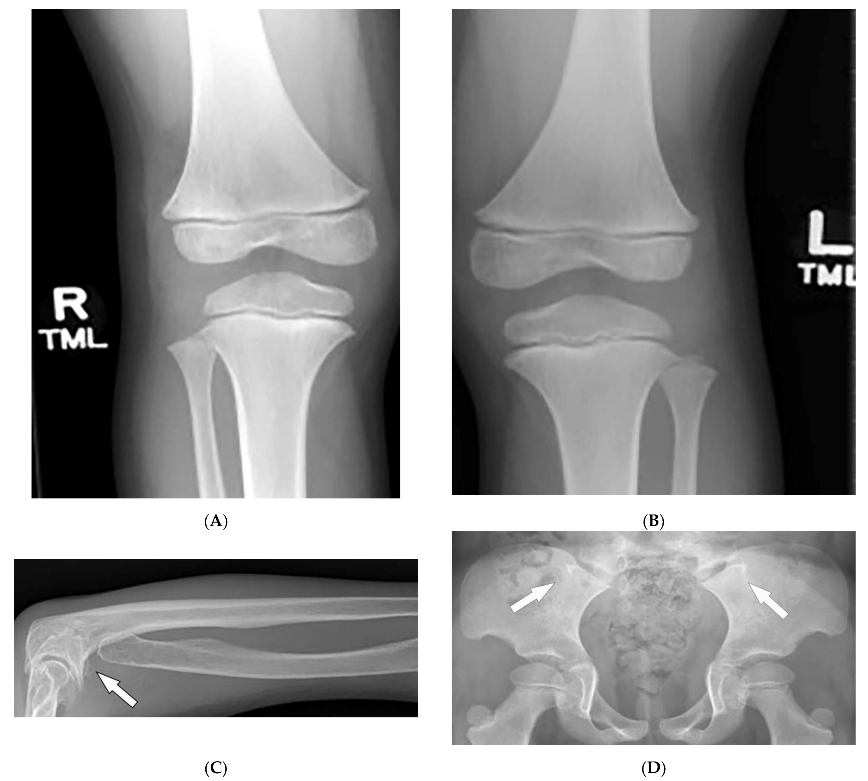 Short stature and hypothyroidism in a child with Nail-Patella Syndrome. A  case report