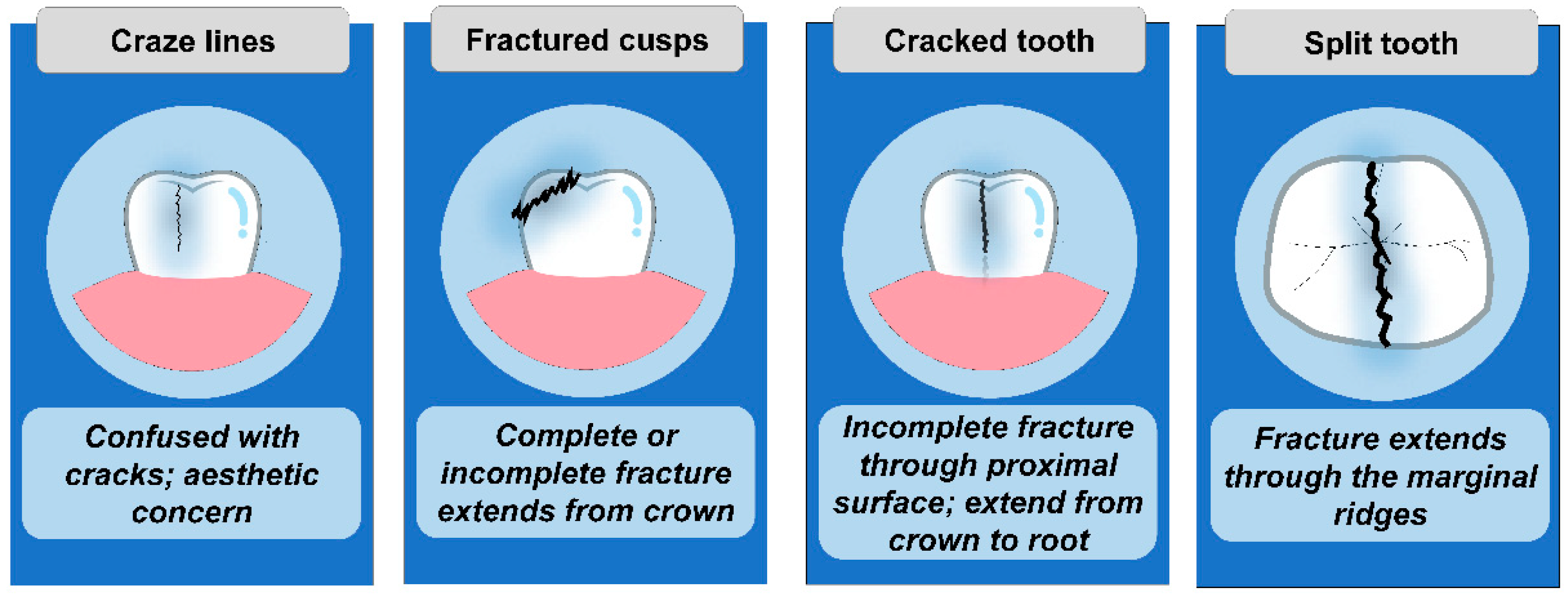 What If I Notice Cracks in My Teeth?