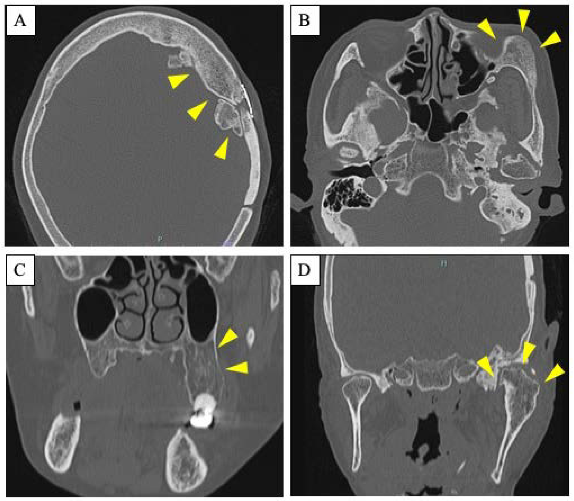 Craniomaxillofacial Fibrous Dysplasia Improved Cosmetic And Occlusal Craniomaxillofacial Fibrous Dysplasia Improved Cosmetic And Occlusal