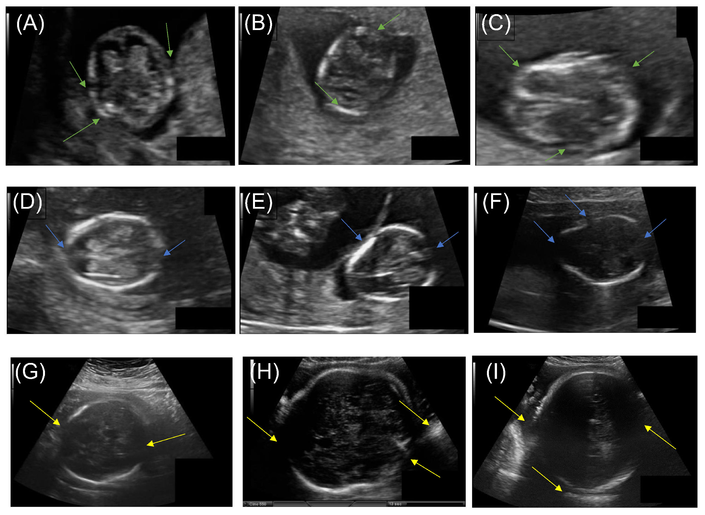 Ensemble Transfer Learning For Fetal Head Analysis From Segmentation Ensemble Transfer Learning For Fetal Head Analysis From Segmentation