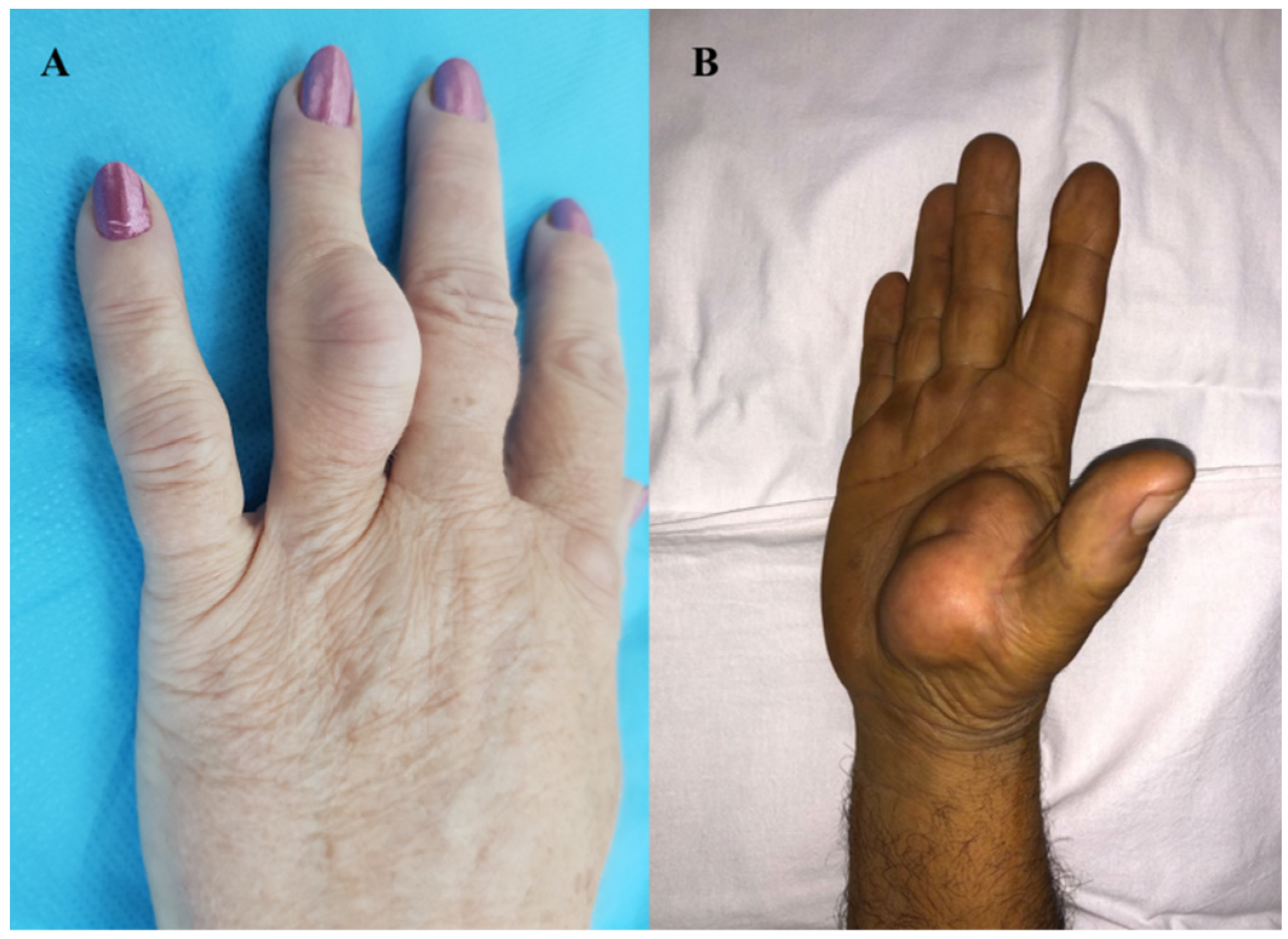 Diagnostics Free Full-Text Atypical Sites of the Lipoma on the Hand and Fingers Clinical and Imaging Features and Surgical Outcomes