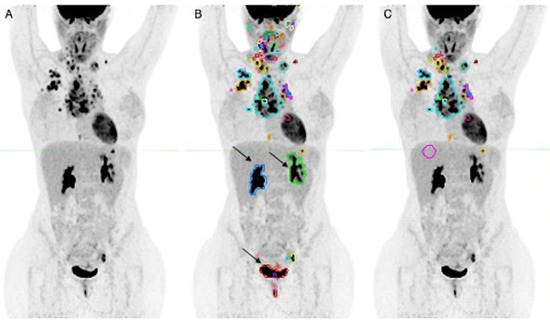 Diagnostics | Free Full-Text | Classical Hodgkin Lymphoma: A Joint ...
