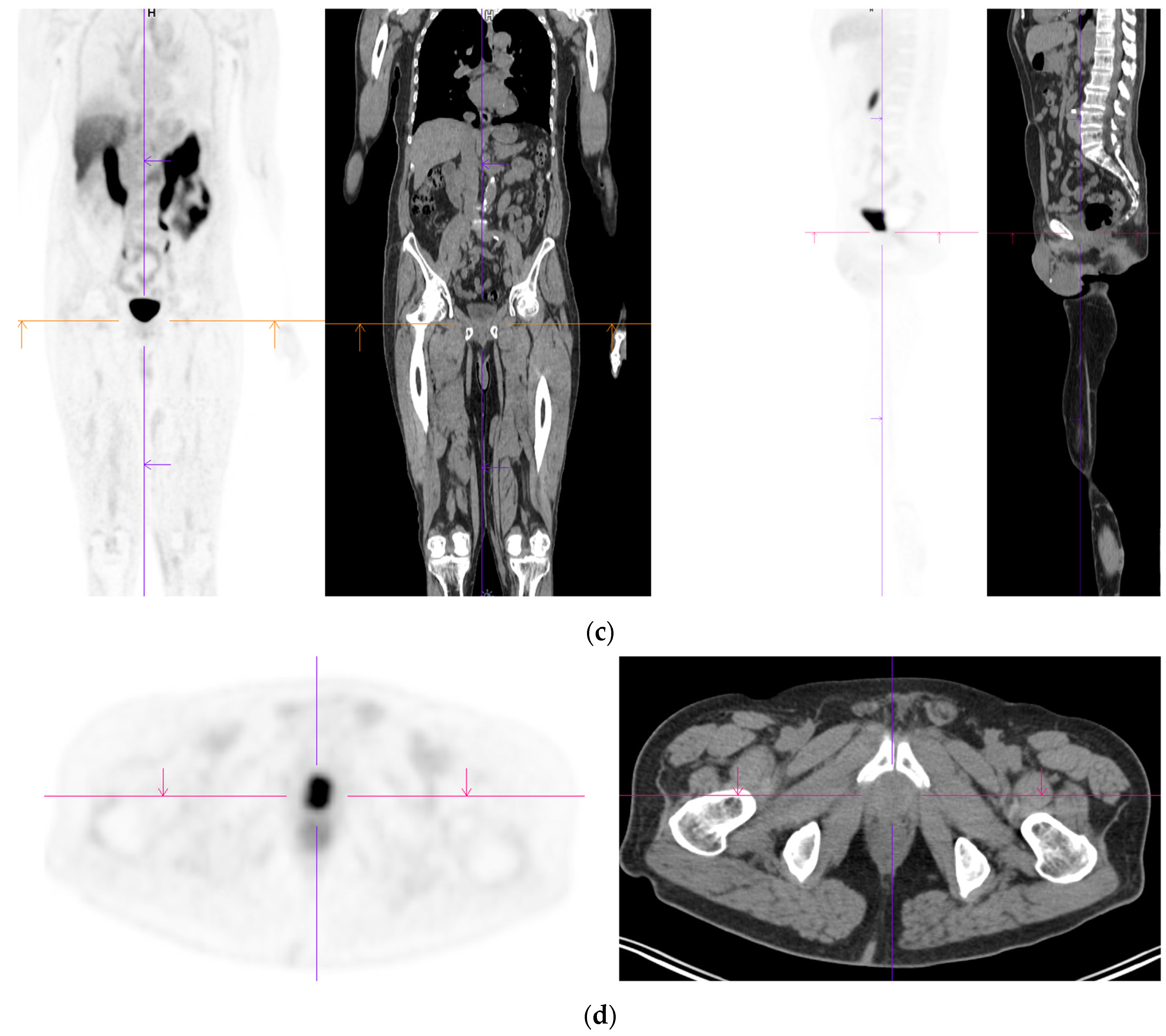 What To Do With a Positive PSMA PET and Negative Conventional Imaging in  Patients With Prostate Cancer