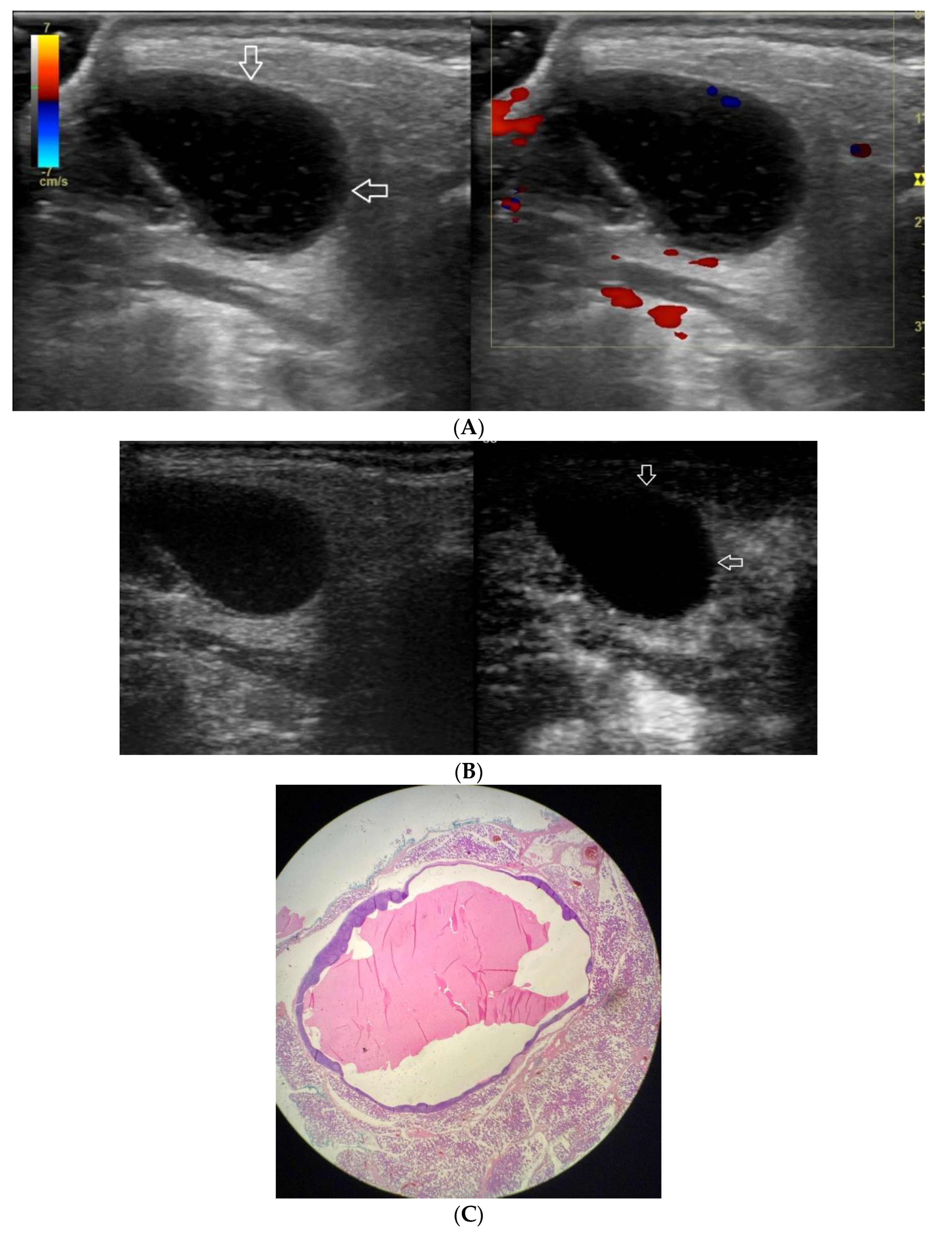 Figure, B-Mode ultrasound showing main portal] - StatPearls - NCBI  Bookshelf