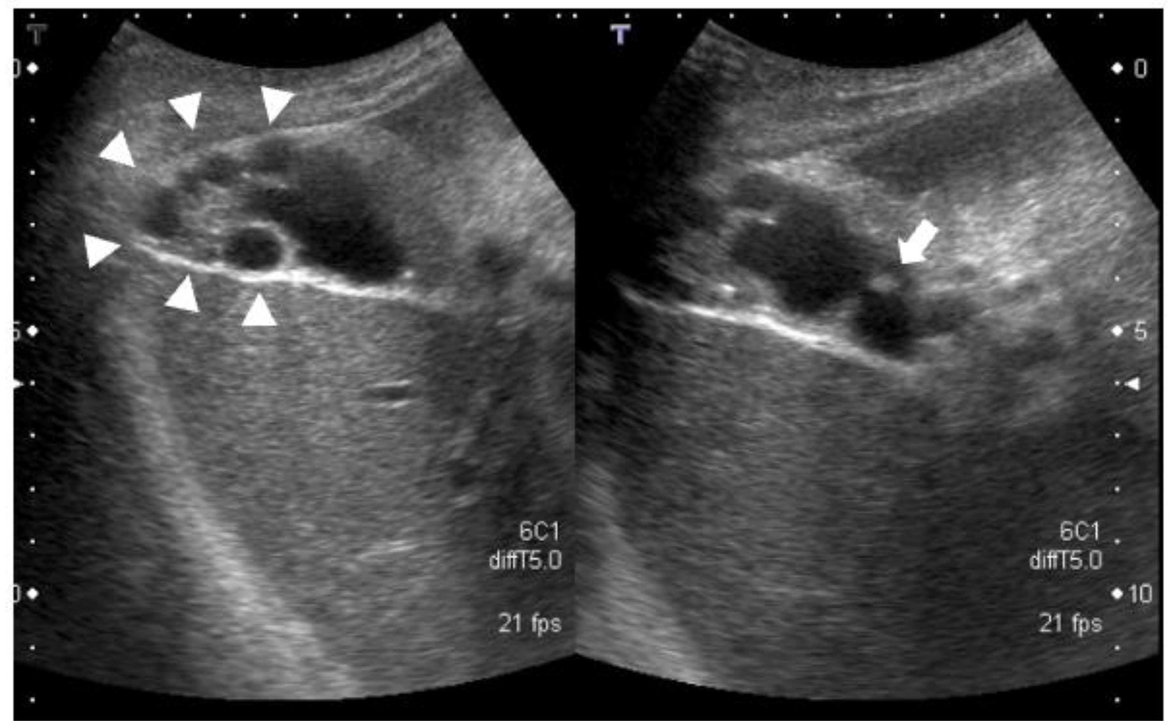 A Case Of Early Stage Gallbladder Cancer Positive For ALDH1A1 Which A Case Of Early Stage Gallbladder Cancer Positive For ALDH1A1 Which