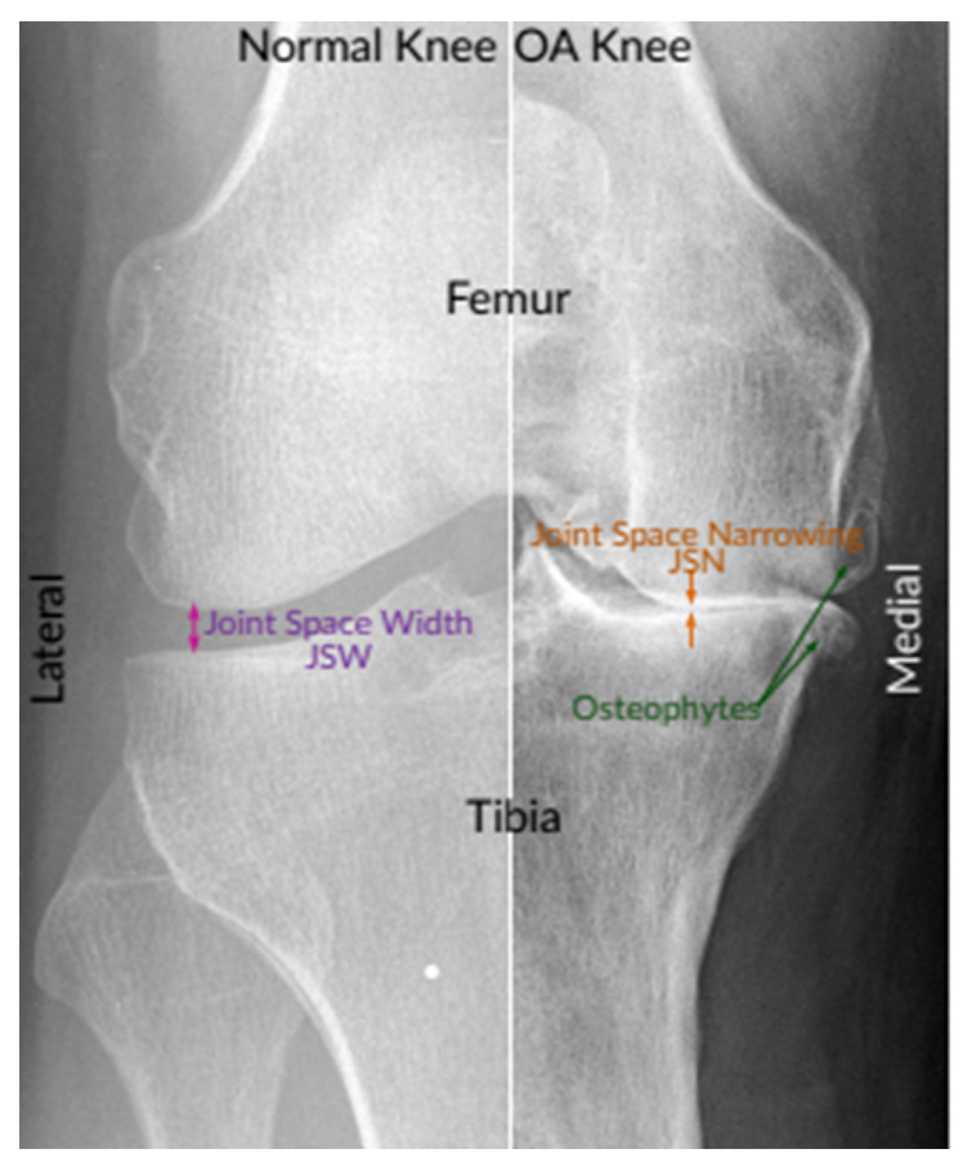 Diagnostics | Free Full-Text | Identifying Severity Grading of Knee ...