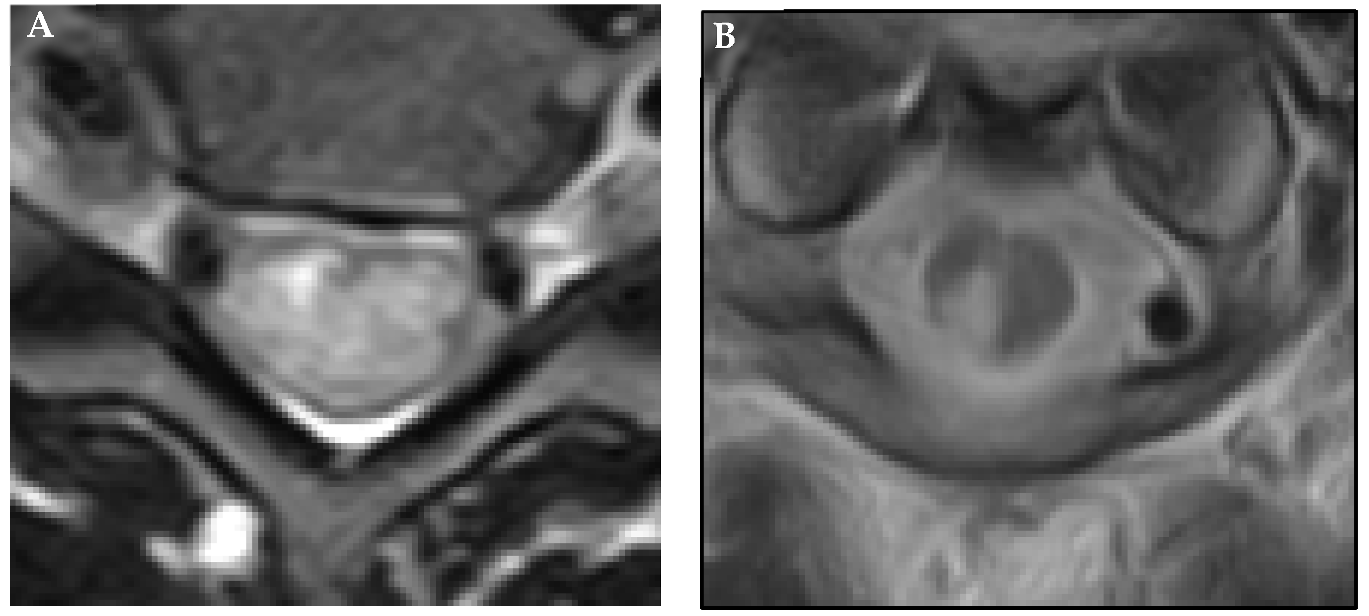 Intramedullary Lesions Multiple Neupsy Key