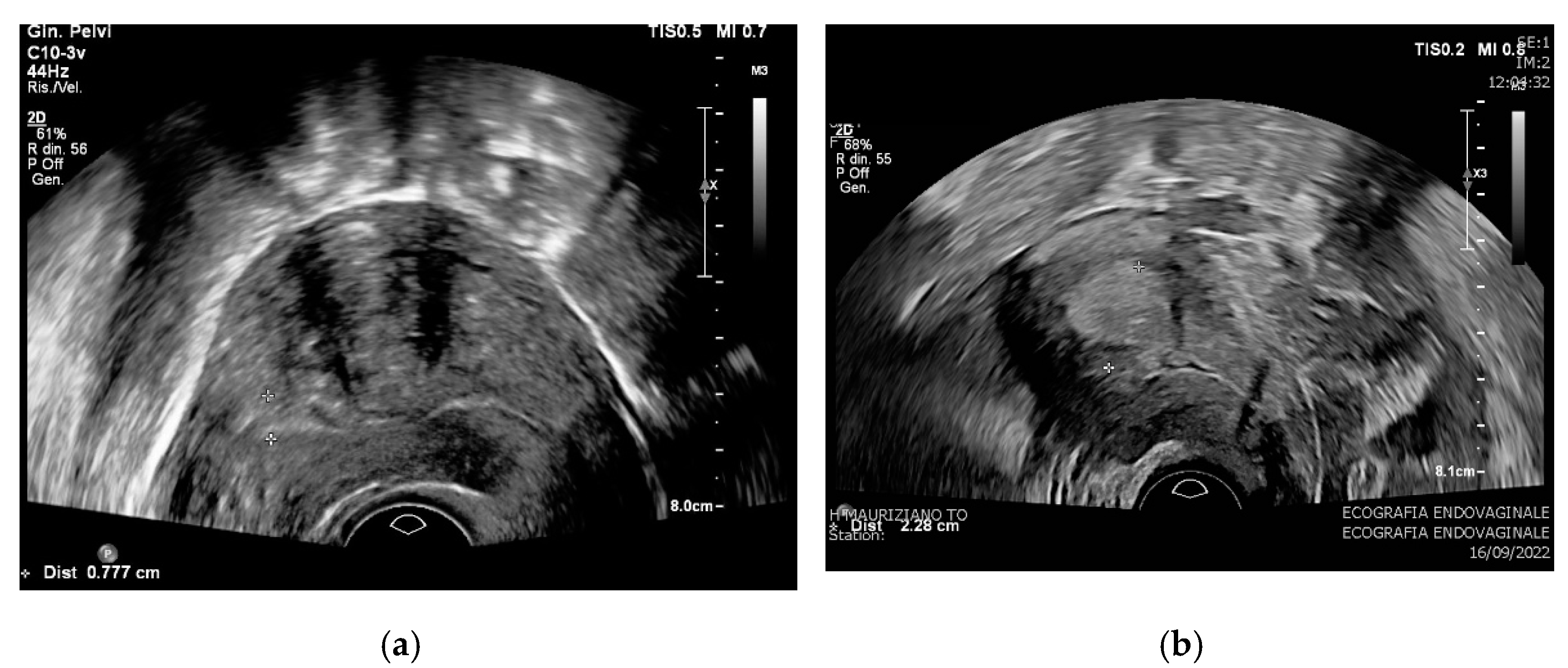 diagnostics-free-full-text-clinical-sonographic-and-hysteroscopic