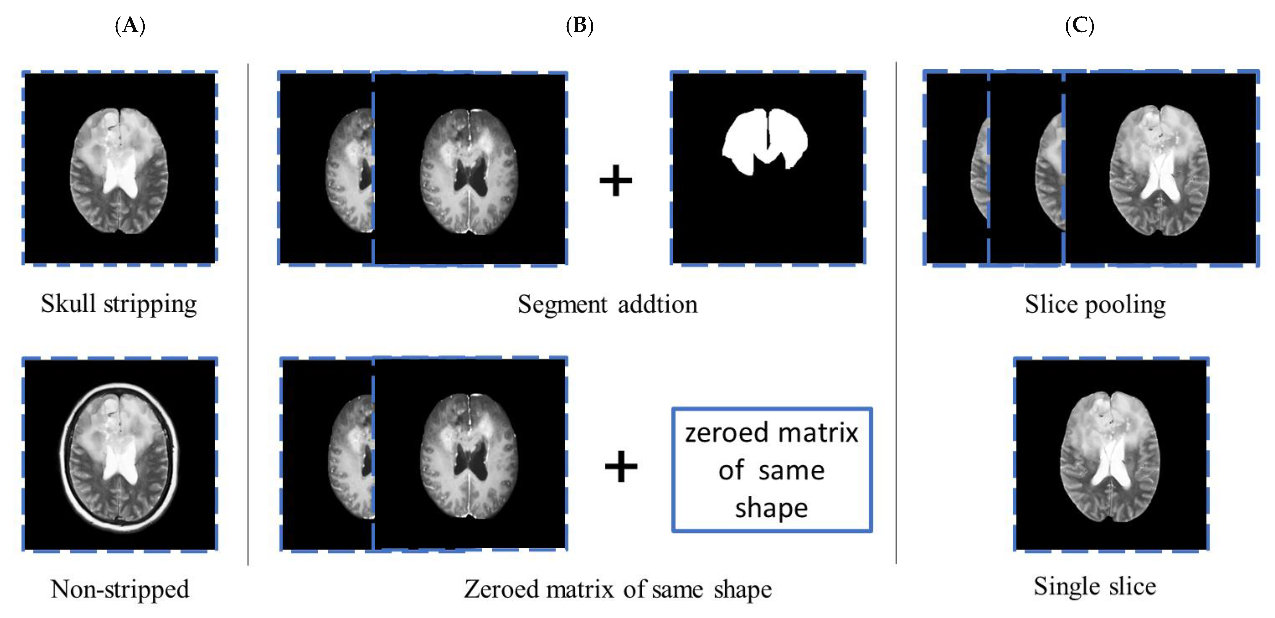 Noninvasive Classification of Glioma Subtypes Using Multiparametric MRI ...