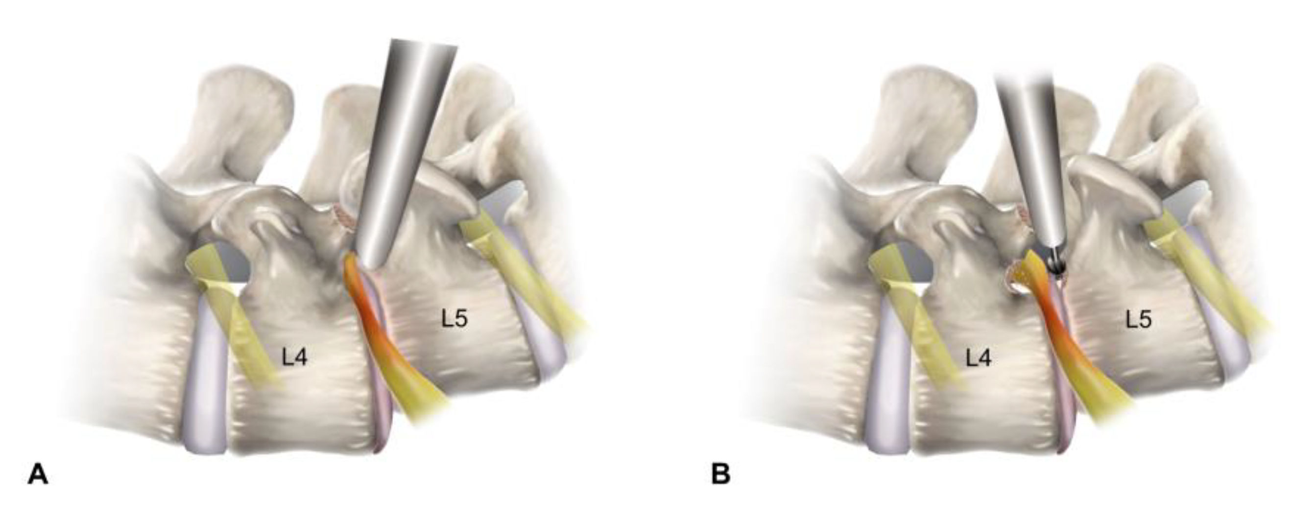 L5-S1 Disc Bulge, Slip Disc, Stenosis & Spondylolisthesis