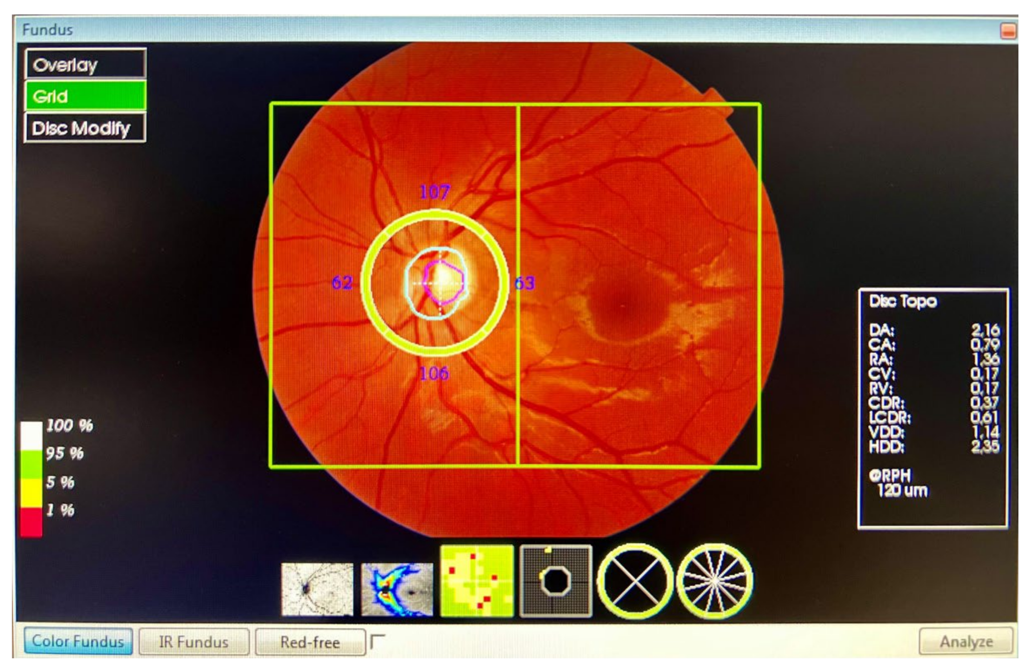 Diagnostics | Free Full-Text | Decrease Retinal Thickness in