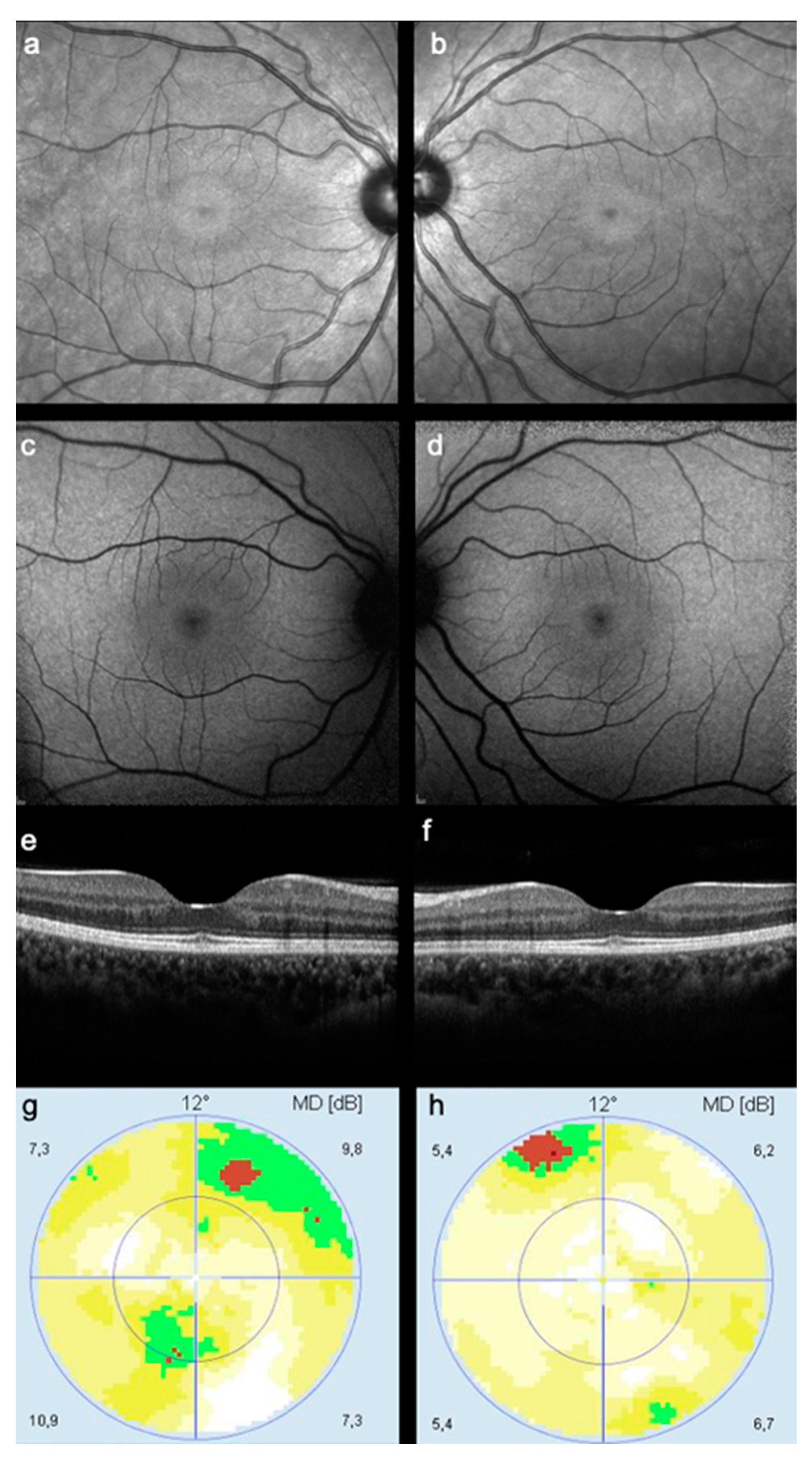 Bull s Eye Maculopathy In Near Infrared Reflectance As An Early Sign Of Bull s Eye Maculopathy In Near Infrared Reflectance As An Early Sign Of