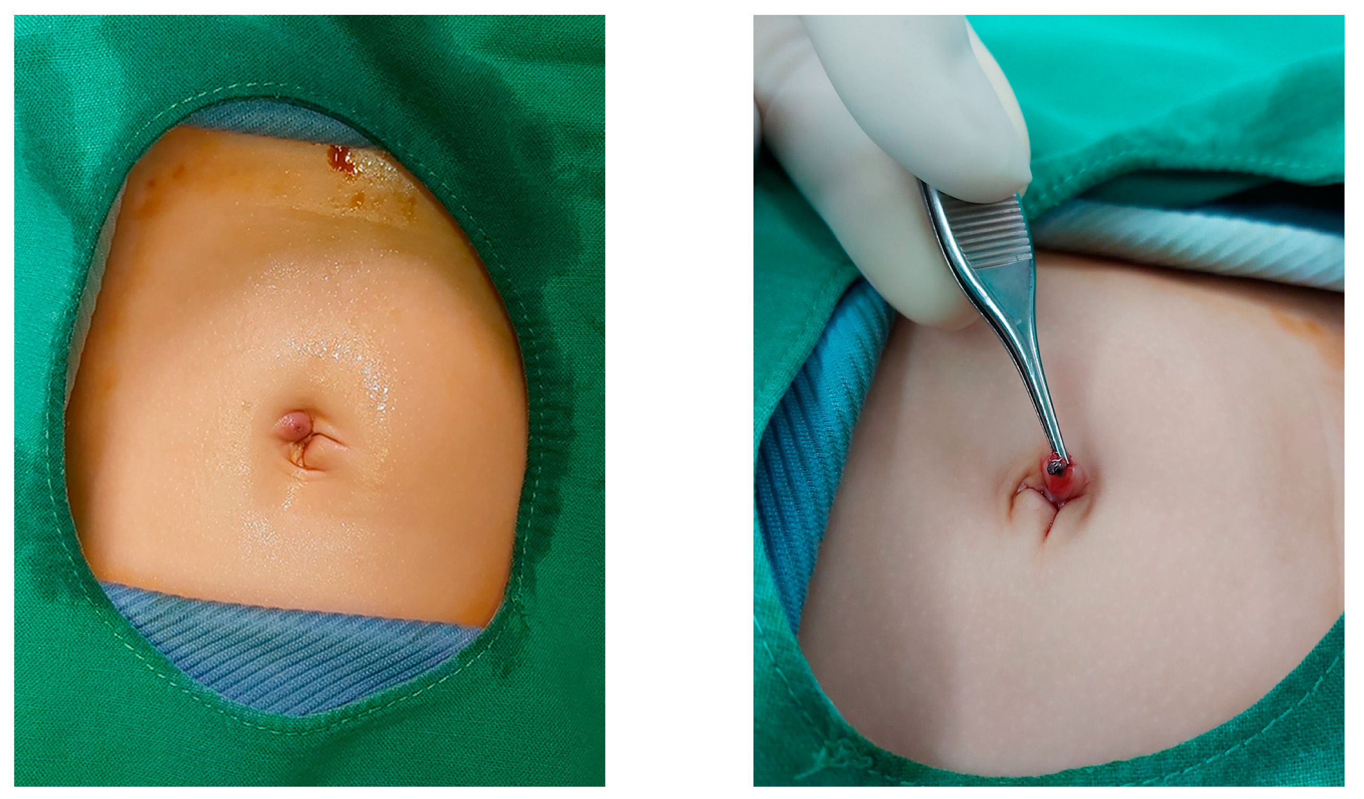 Kids Pelvic Surgery - Umbilical Hernia (Belly button hernia or naaf ka  hernia) is a commonly seen condition in newborn babies. Its causes,  symptoms, presentation, treatment, and surgery is being explained here.