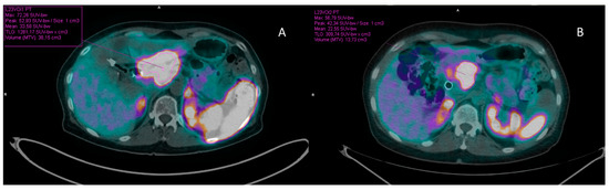 Relevance of Volumetric Parameters Applied to [68Ga]Ga-DOTATOC PET/CT ...