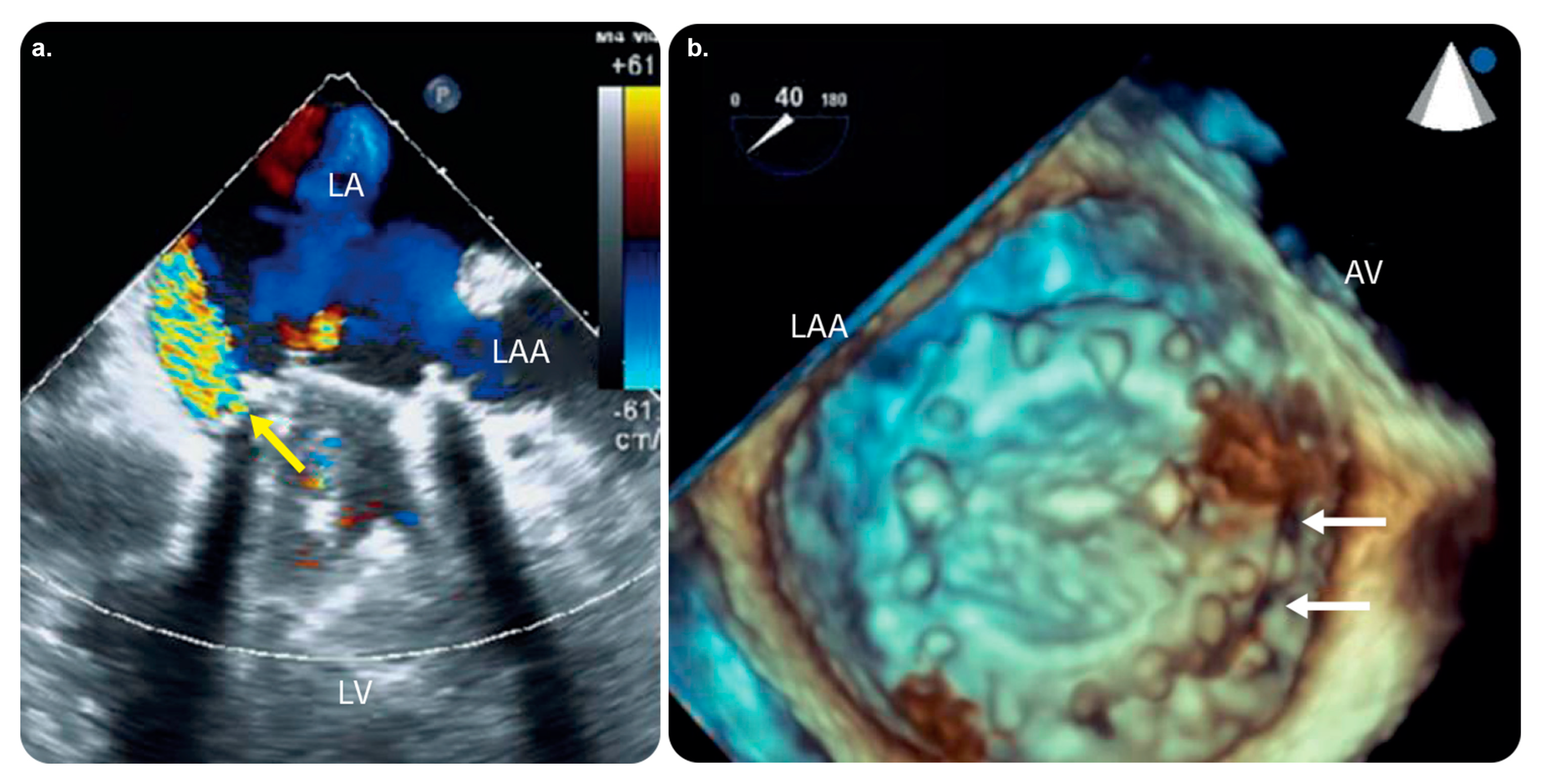 Roadmap Fusion Imaging in Percutaneous Coronary Intervention