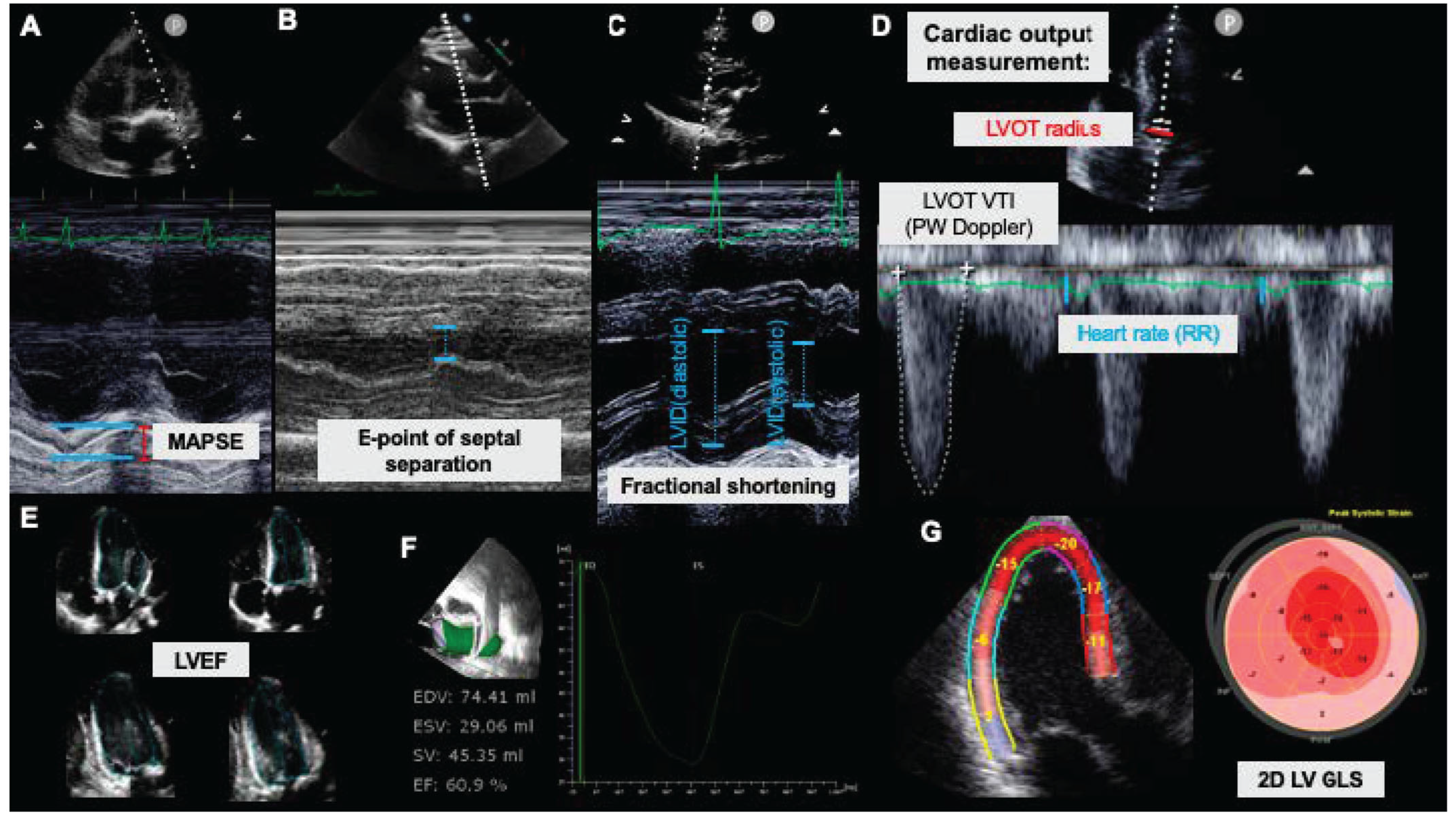 Analysis of myocardial strain of the left ventricle based on 2-D