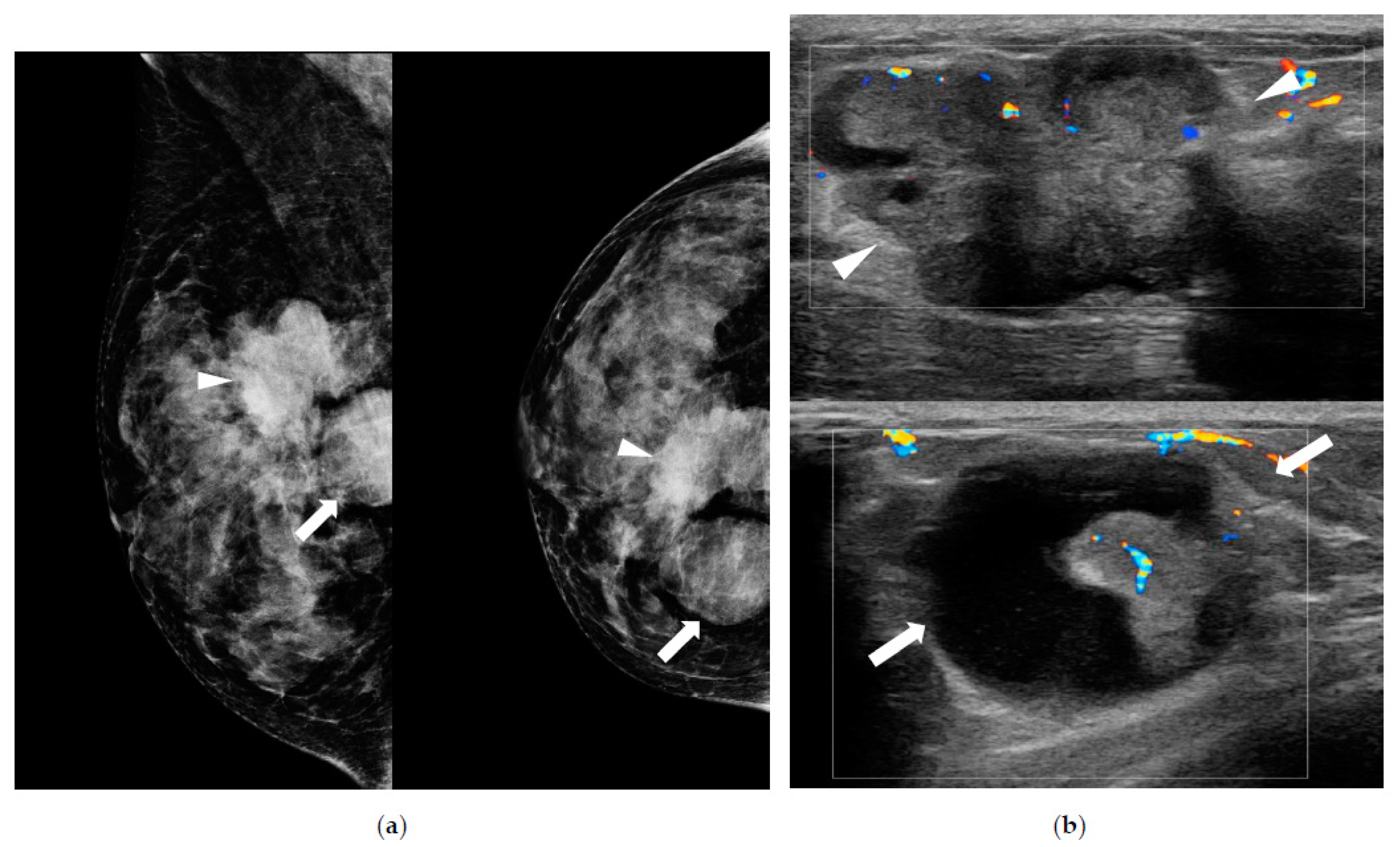 Breast ultrasonography revealed a 36-mm irregular mass at the 9 o