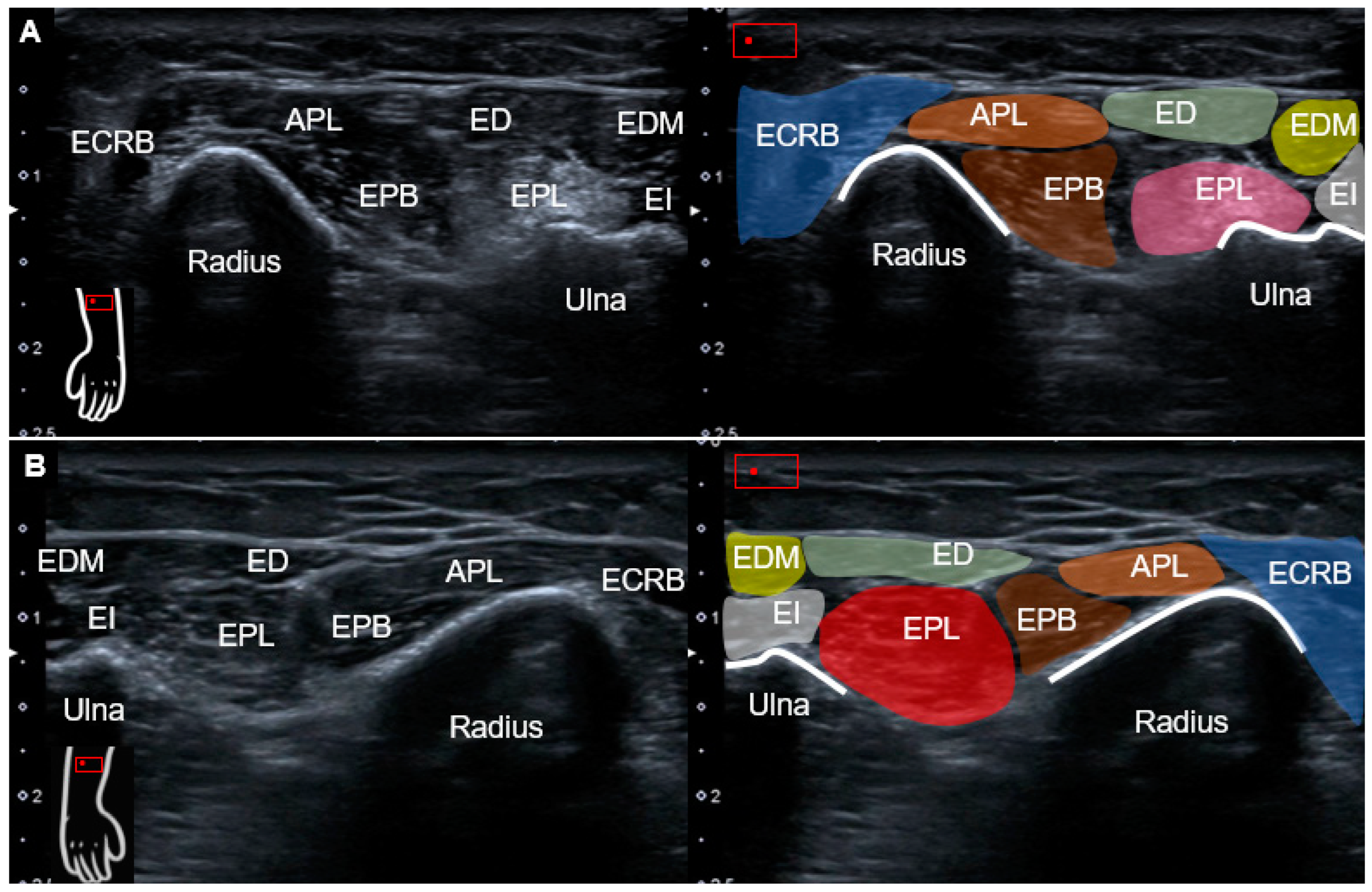 Extensor Tendonitis Injection At Francis Needham Blog Extensor Tendonitis Injection At Francis Needham Blog