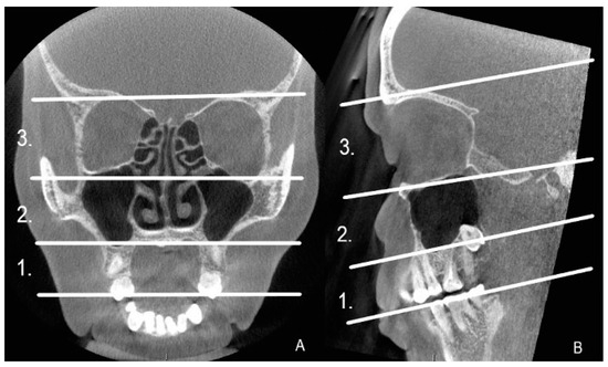 Retrospective Analysis of Artifacts in Cone Beam Computed Tomography ...