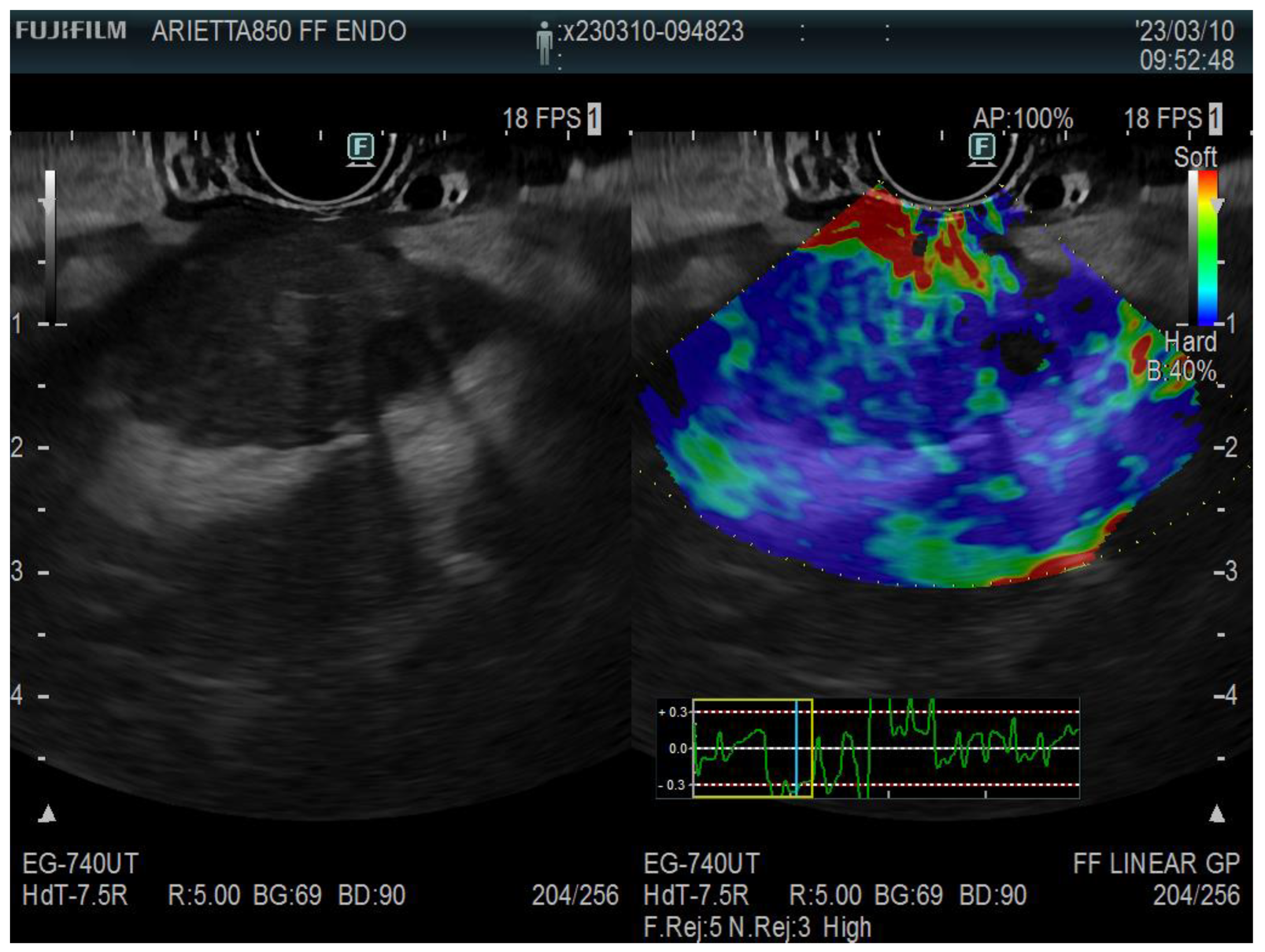 Endoscopic Ultrasound EUS Guided Elastography Endoscopic Ultrasound EUS Guided Elastography
