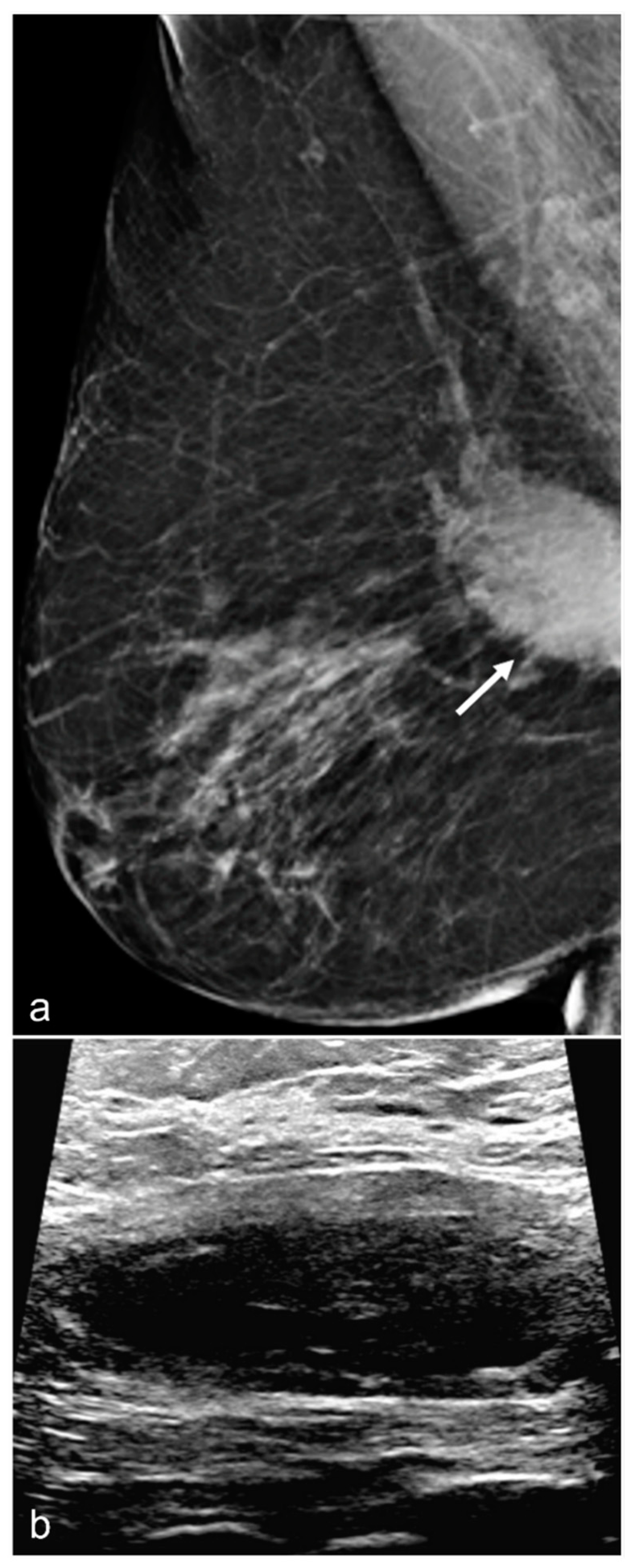 Imaging Features Following Breast Explant Surgery A Pictorial Essay