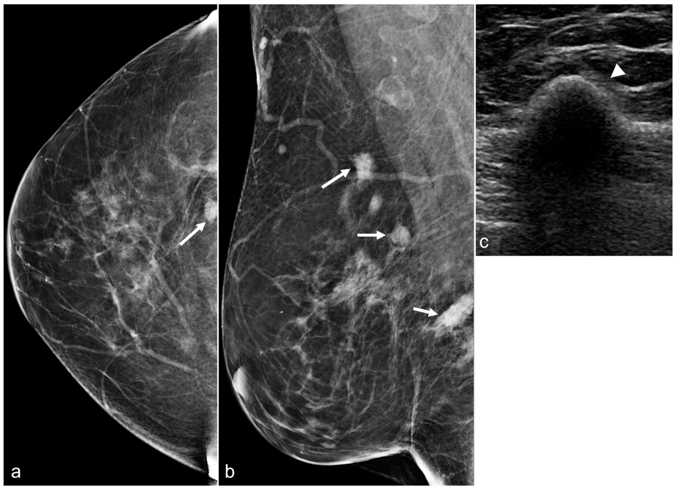 Imaging Features Following Breast Explant Surgery: A Pictorial Essay