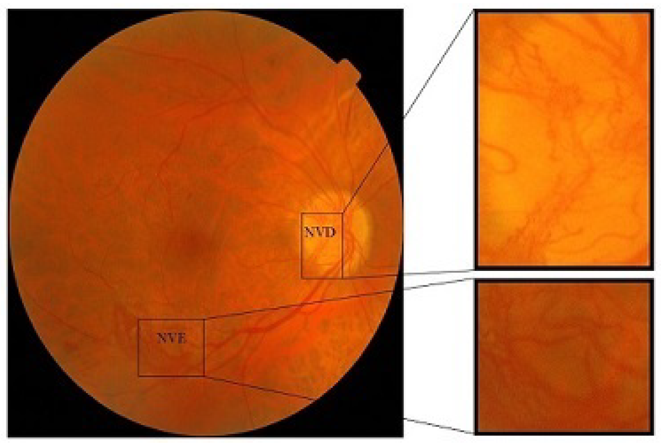 diagnostics-free-full-text-proliferative-diabetic-retinopathy