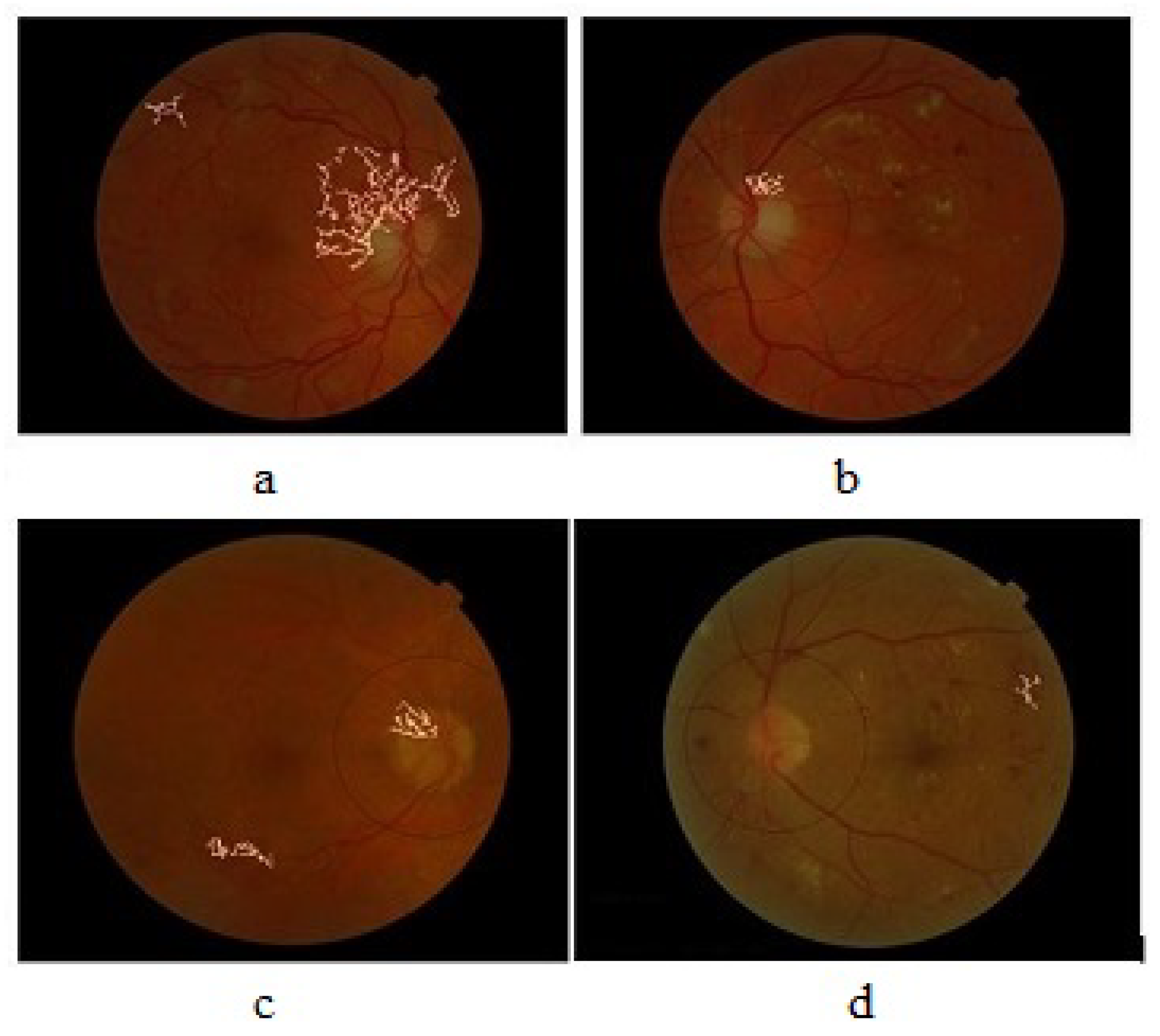 Diagnostics | Free Full-Text | Proliferative Diabetic Retinopathy ...