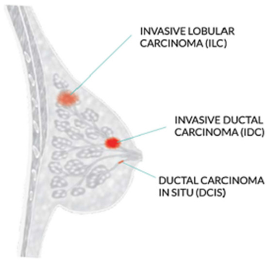 Invasive Ductal Carcinoma Diagram