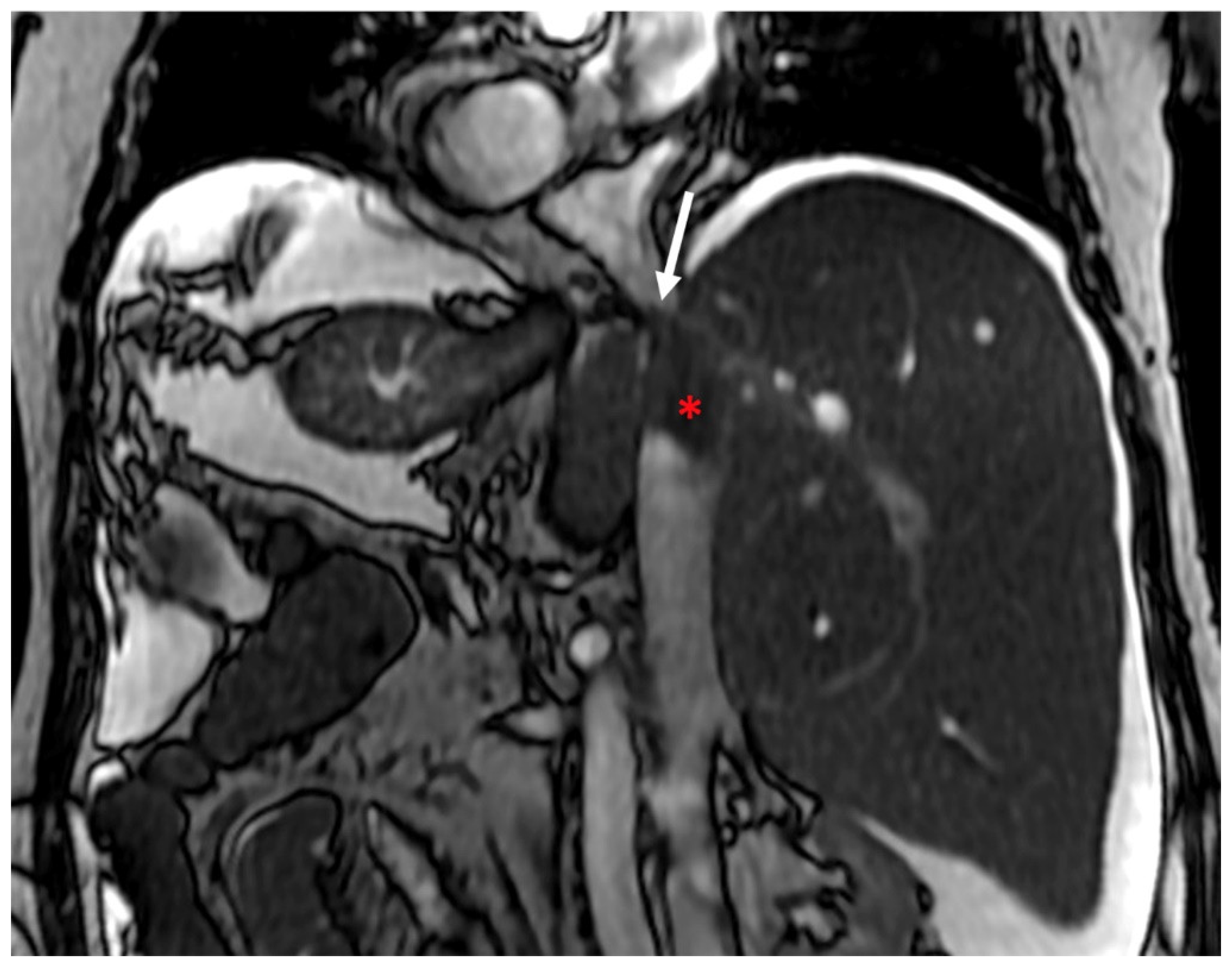 Diagnostics | Free Full-Text | Budd-Chiari Syndrome Imaging Diagnosis ...