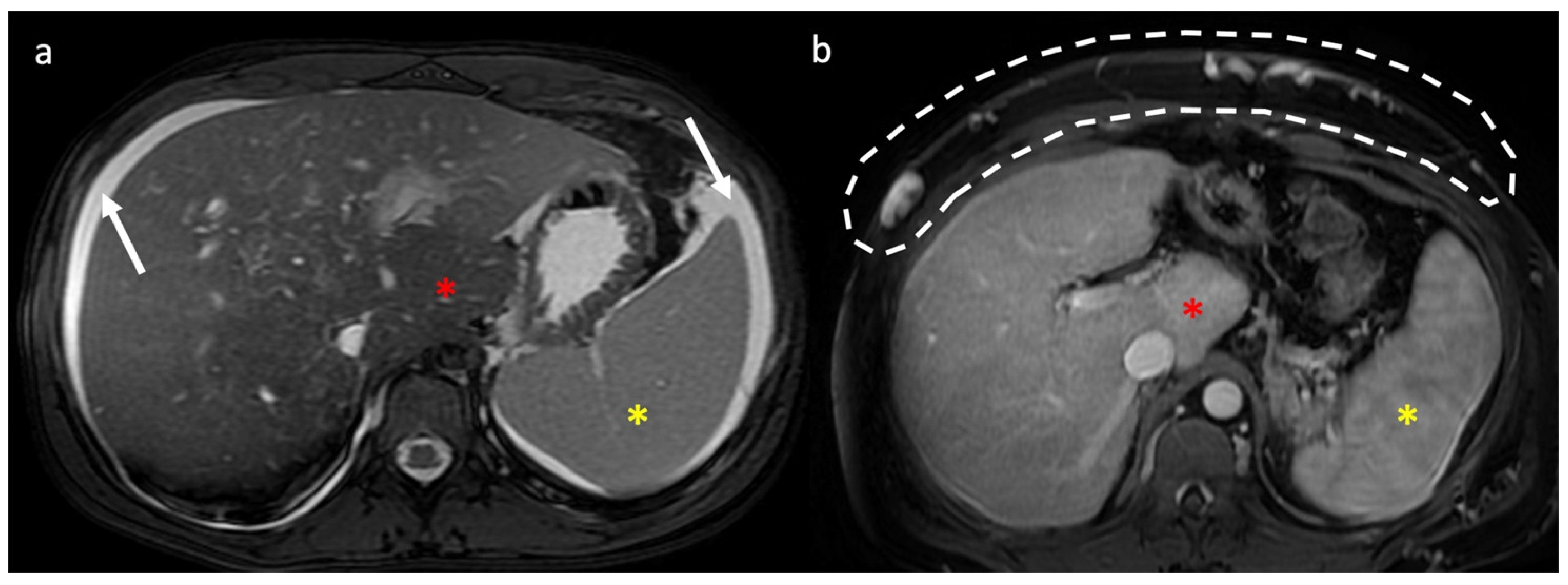 Diagnostics | Free Full-Text | Budd-Chiari Syndrome Imaging Diagnosis ...