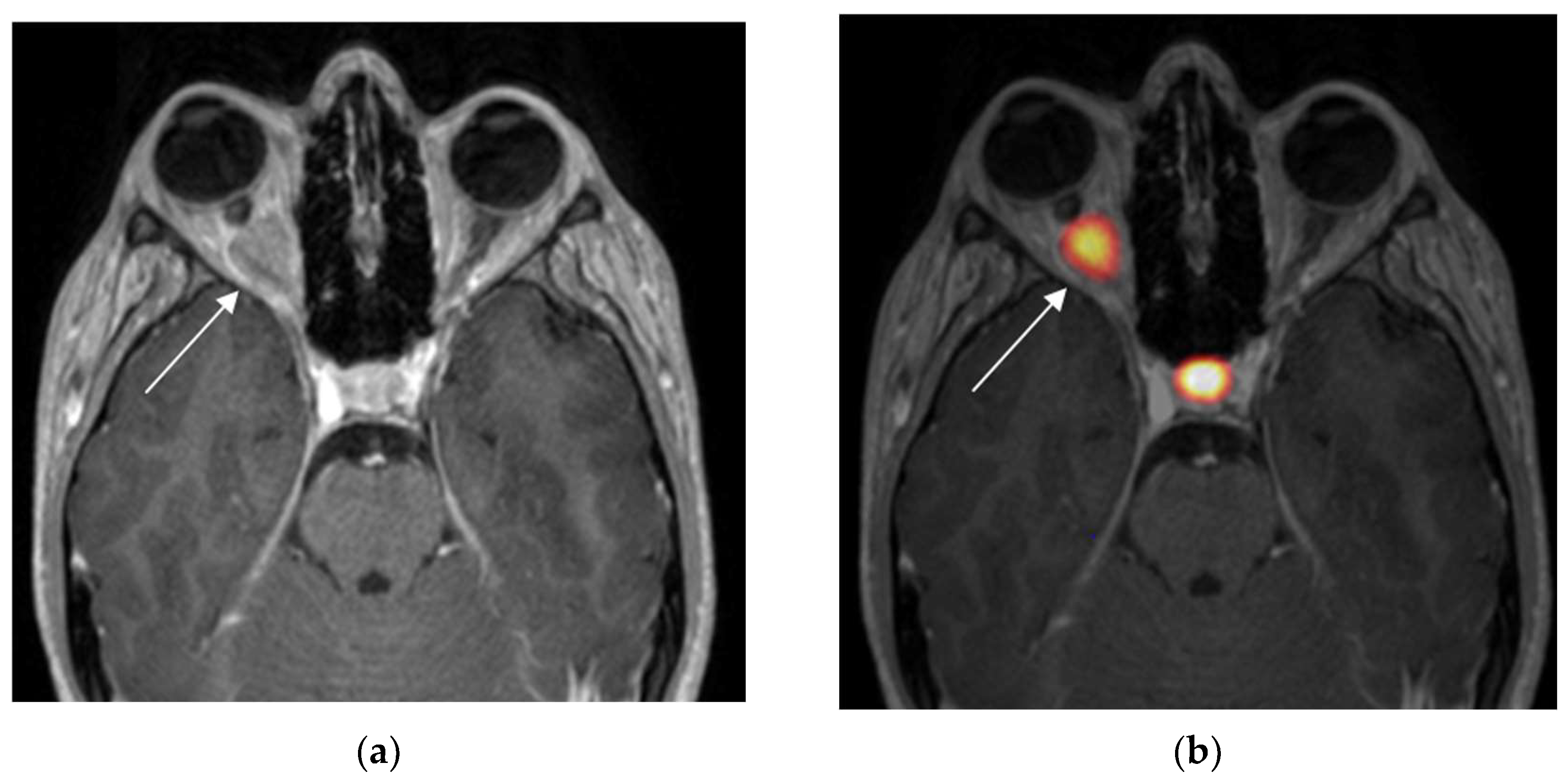 diagnostics-free-full-text-optic-nerve-sheath-meningiomas-solving