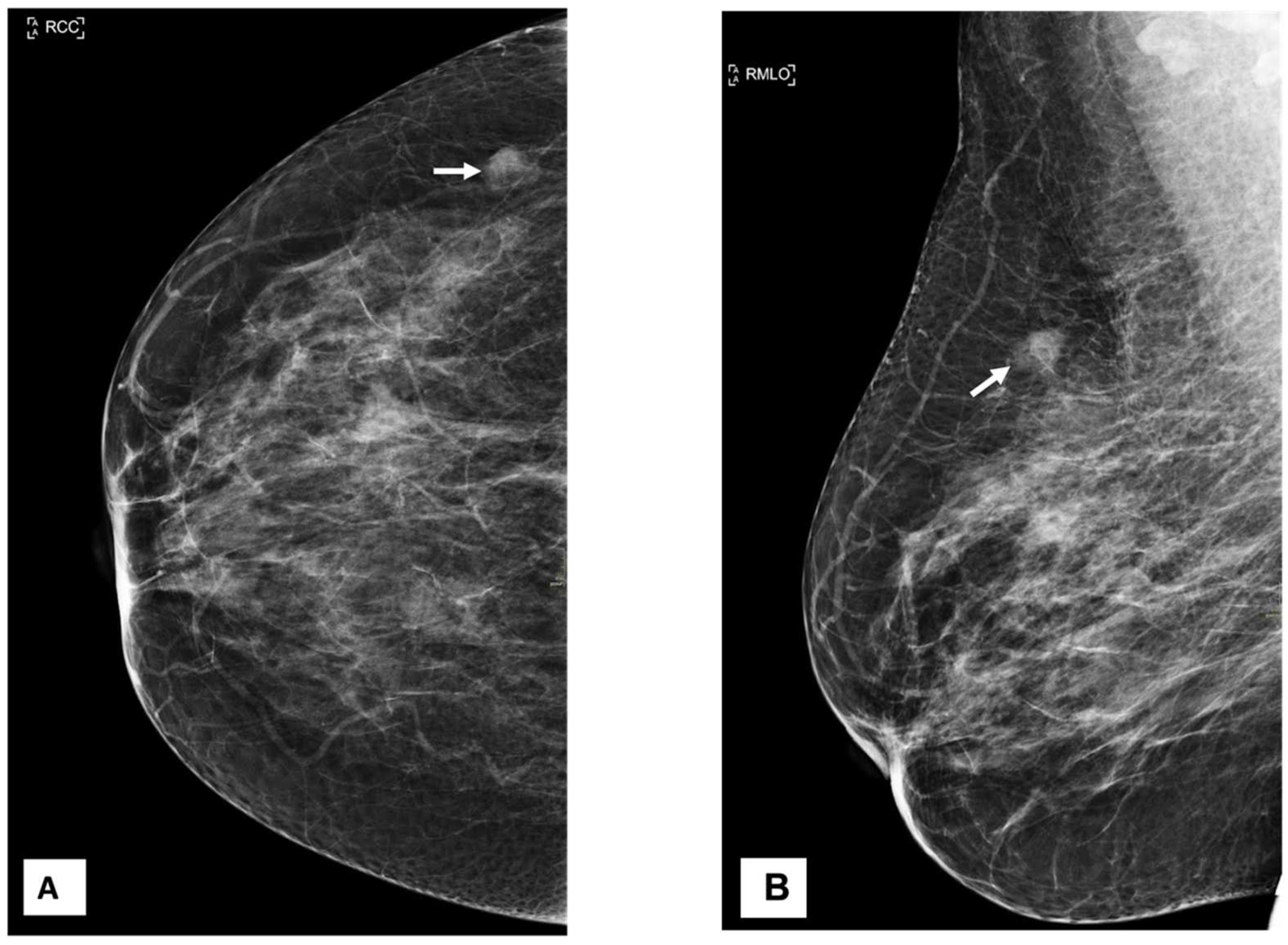 b. Left breast USG showing oval, well-defined, mixed echogenic