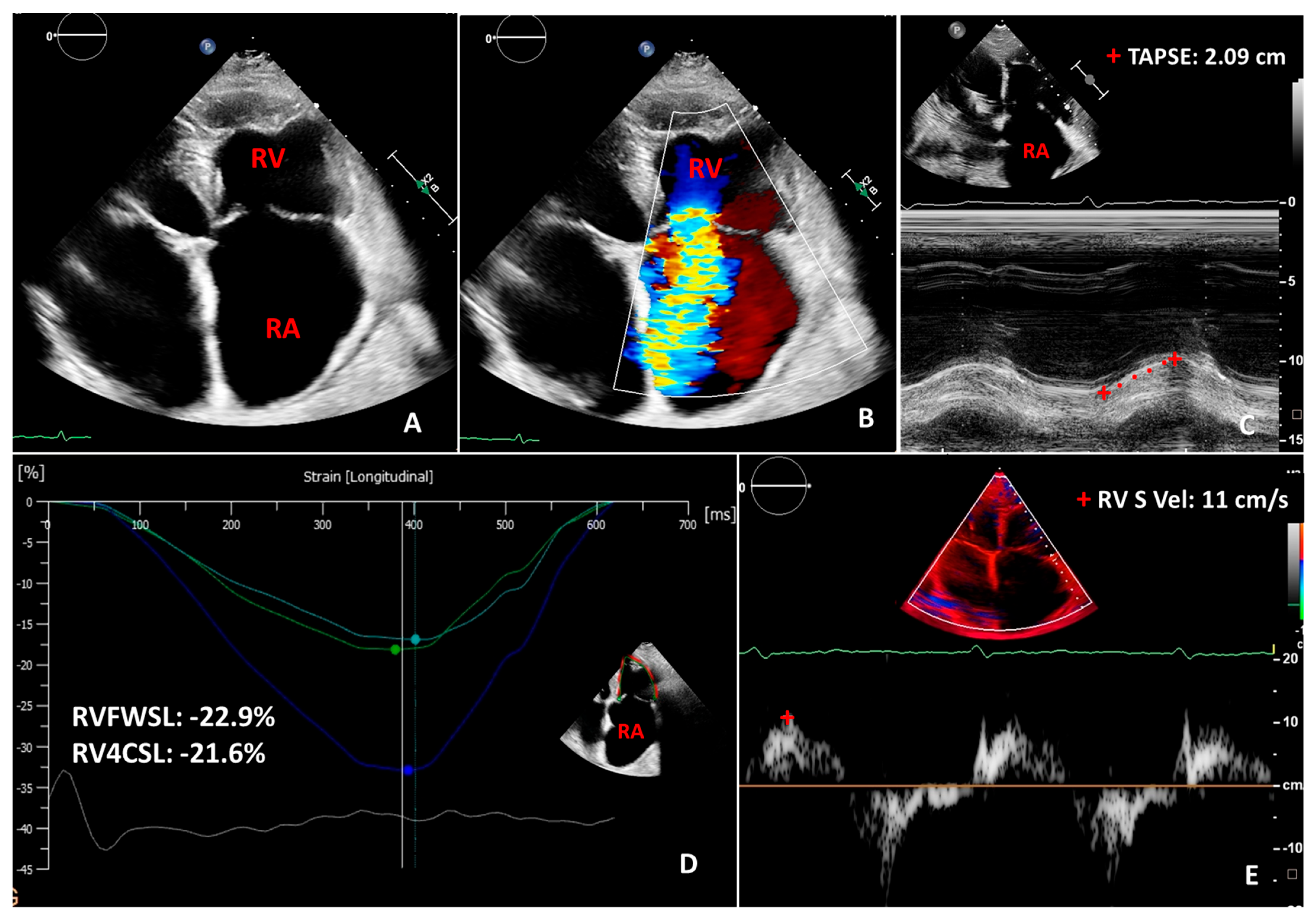 Right ventricle /LV/band models at end-ejection (minimum RV volume