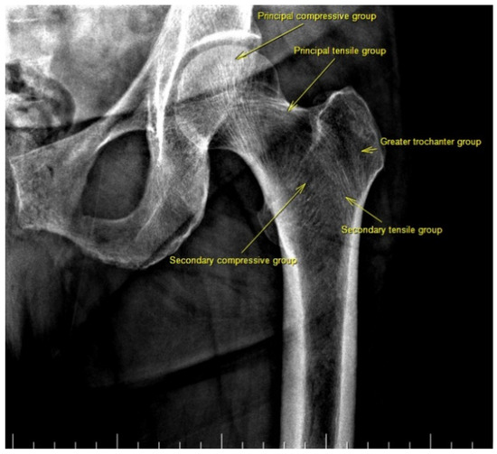 trabecular bone xray