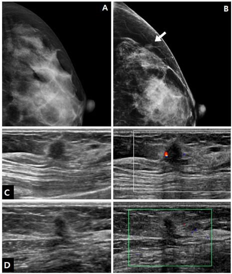 Breast ultrasonography revealed a 36-mm irregular mass at the 9 o
