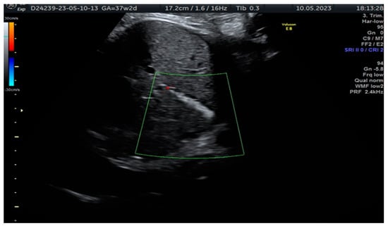 Sonographic Detection Of Fetal Cholelithiasis