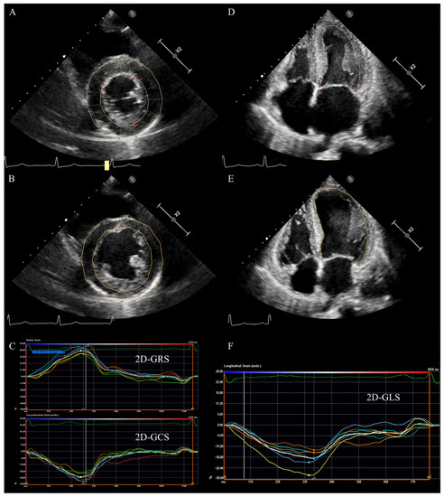 The value of 2D speckle-tracking strain echocardiography in evaluating the  relationship between carotid elasticity and left ventricular systolic  function in patients with diabetic nephropathy, Insights into Imaging