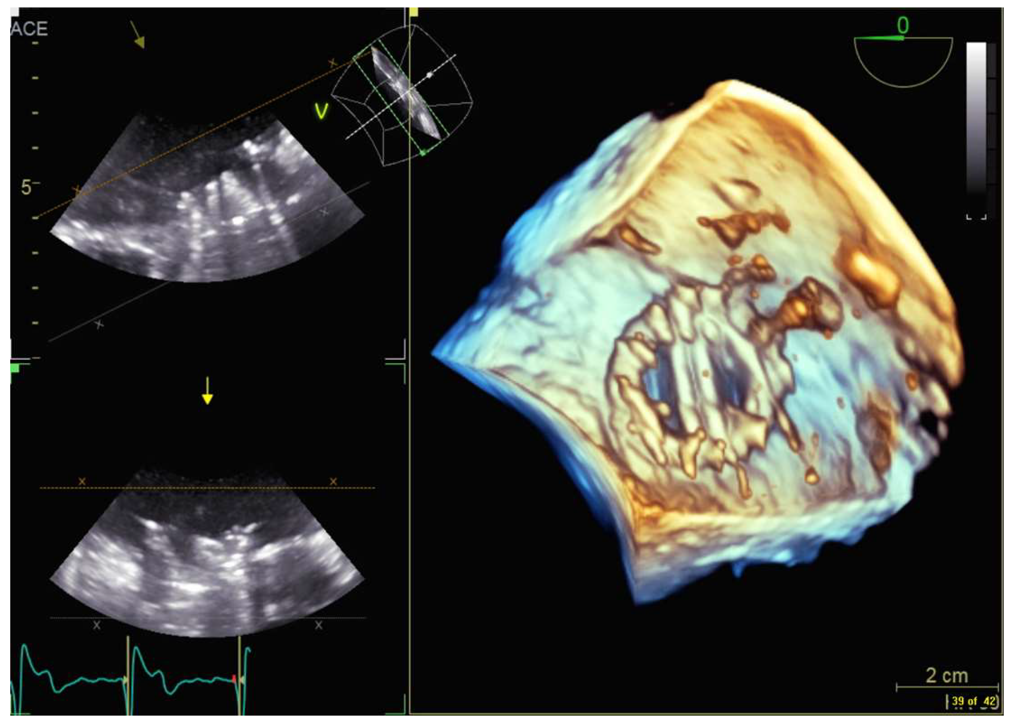 Transesophageal echocardiography - Hamilton Cardiology Associates