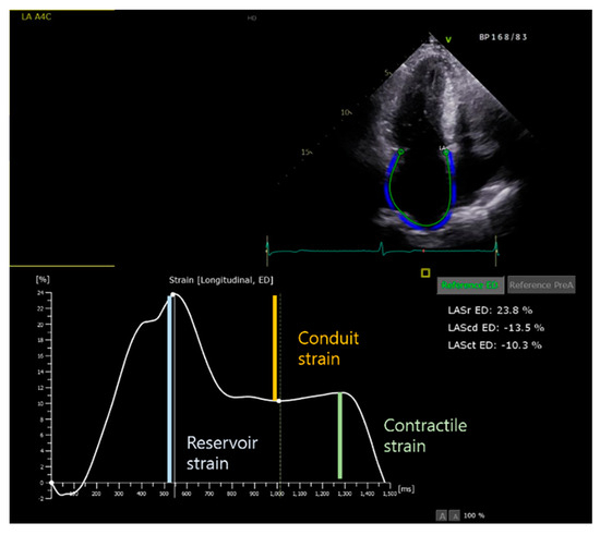 Evaluation of left ventricular strain in patients with arrhythmia