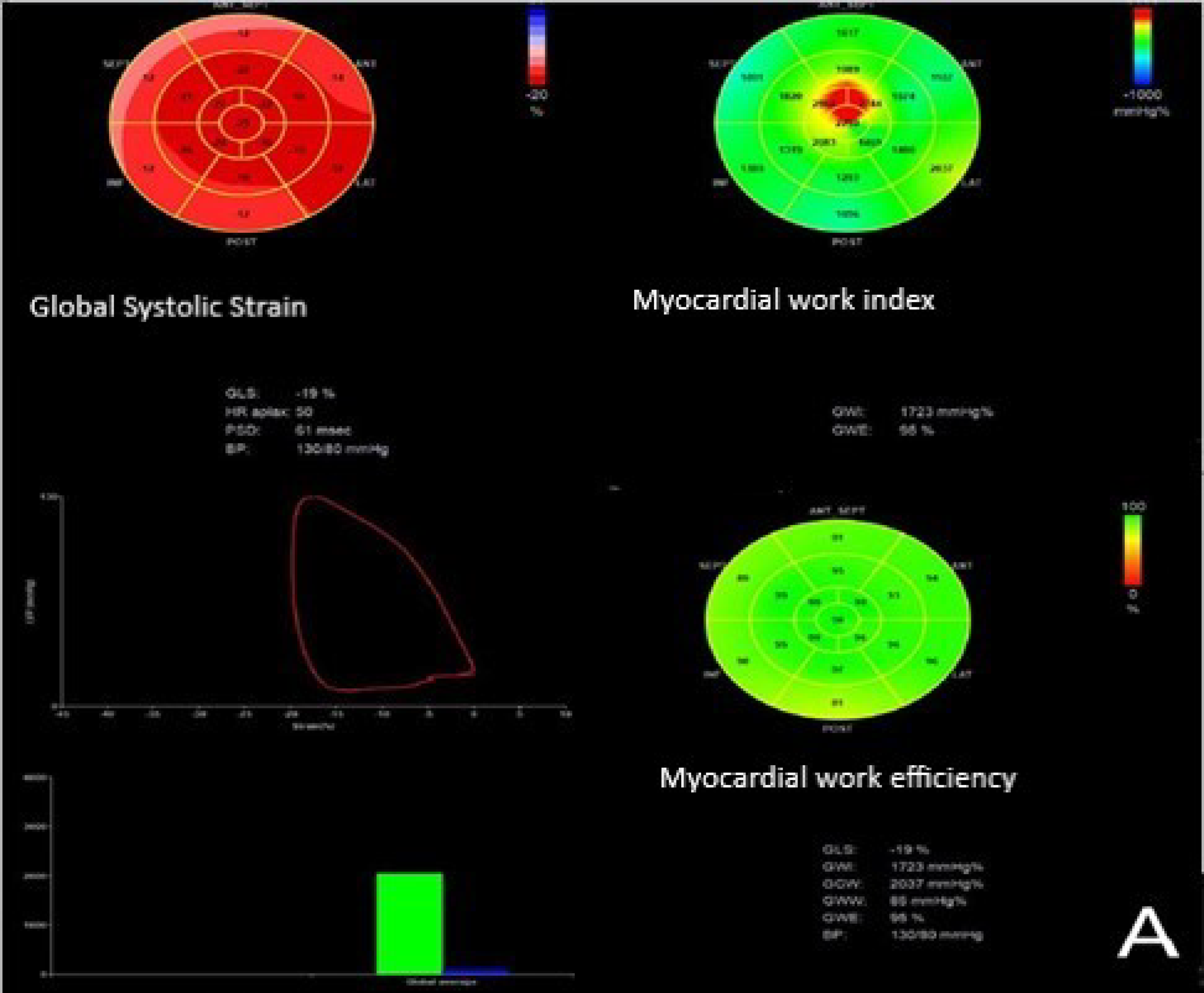 Improvement of left ventricular function assessment by global longitudinal  strain after successful percutaneous coronary intervention for chronic  total occlusion