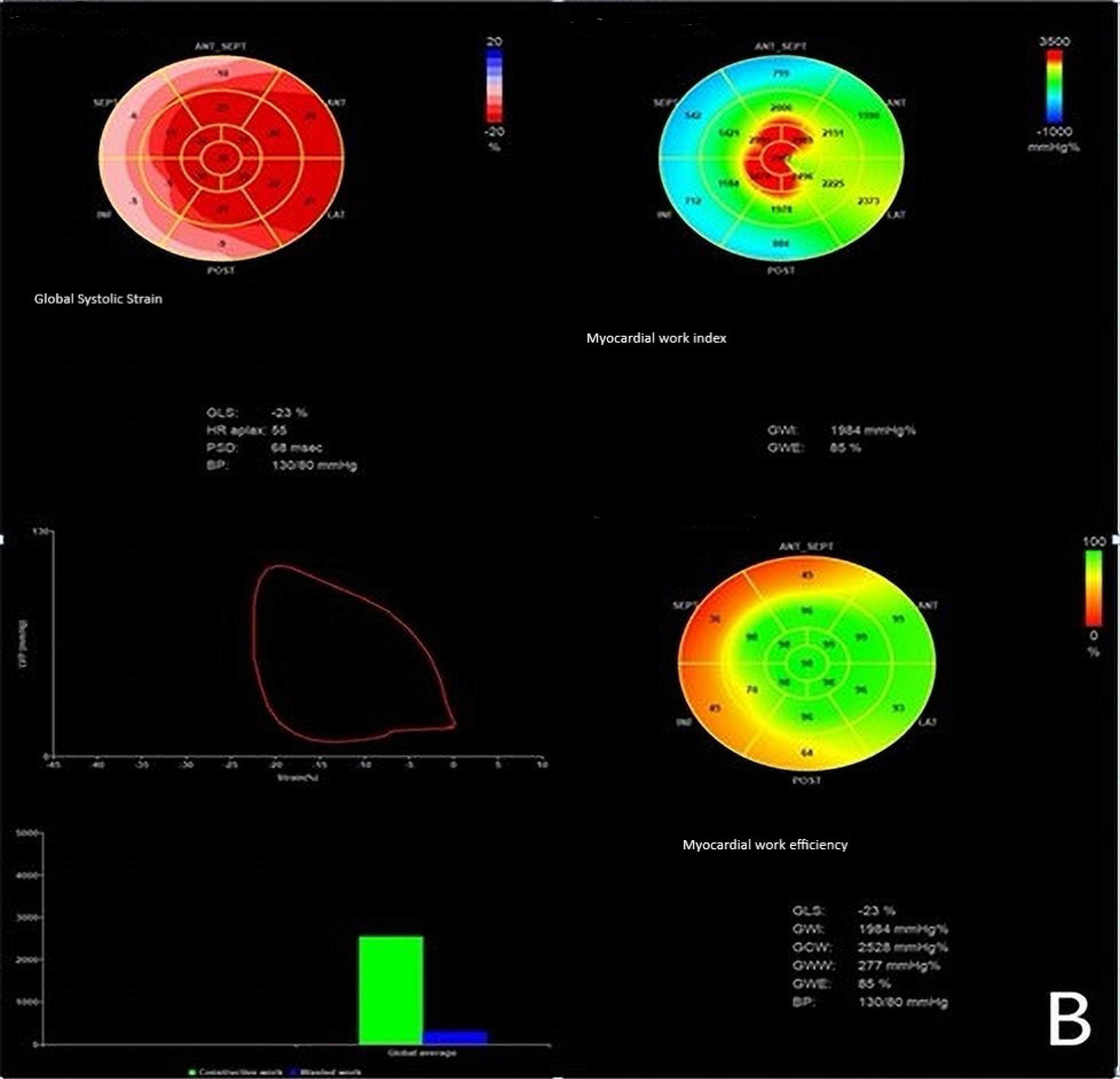 Improvement of left ventricular function assessment by global longitudinal  strain after successful percutaneous coronary intervention for chronic  total occlusion