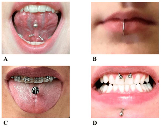 Do Tongue Piercings Ruin Your Teeth: 7 Impacts & 4 Factors – Dr. Numb®