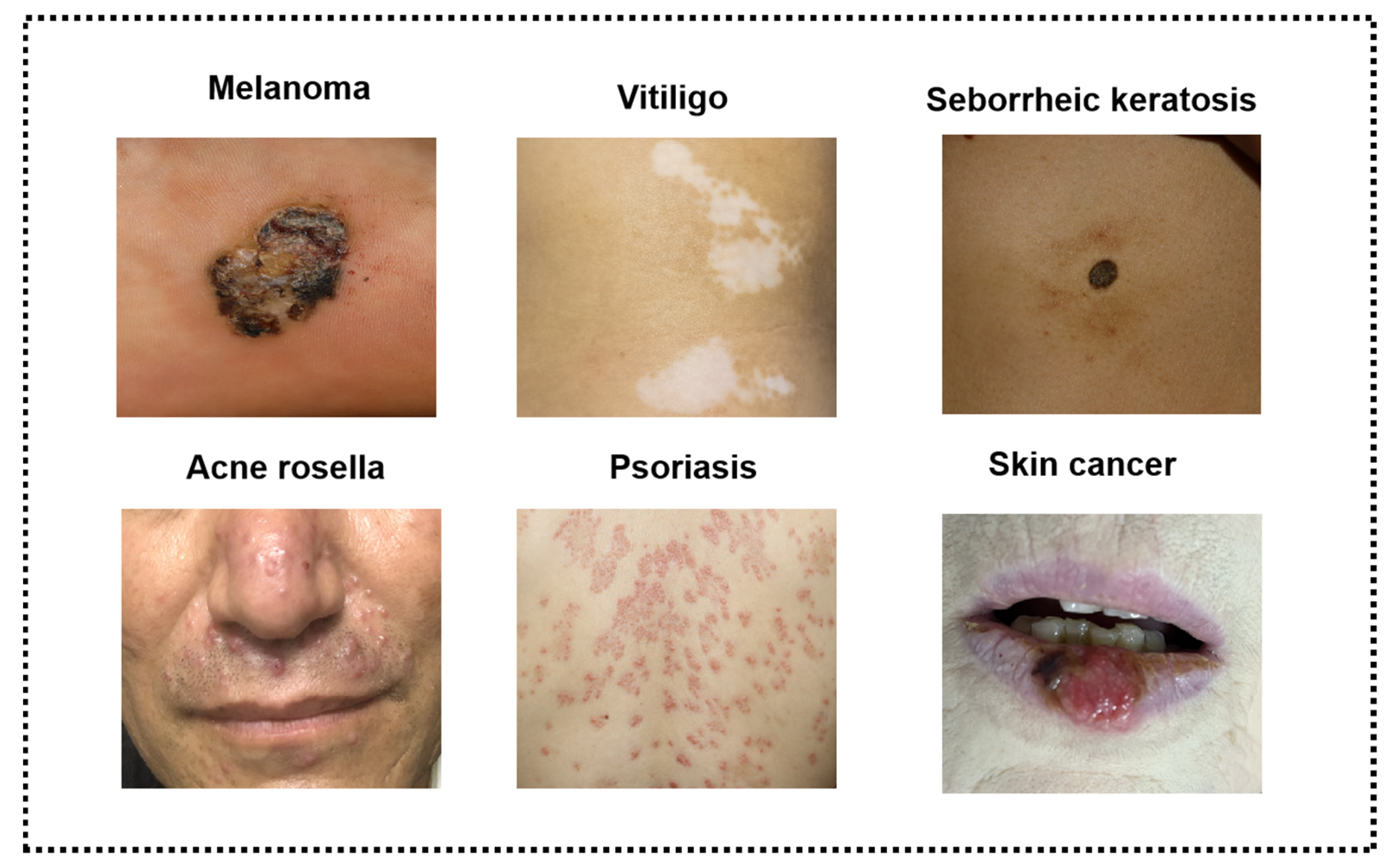 List of Skin Diseases With Pictures
