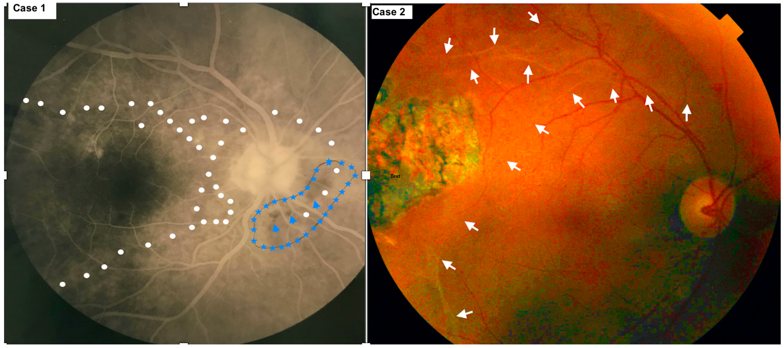 Presumed Onchocerciasis Chorioretinitis Spilling Over Into North Presumed Onchocerciasis Chorioretinitis Spilling Over Into North
