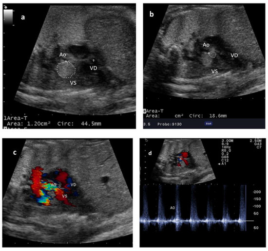 Diagnostics | Free Full-Text | Regression of Cardiac Rhabdomyomas ...