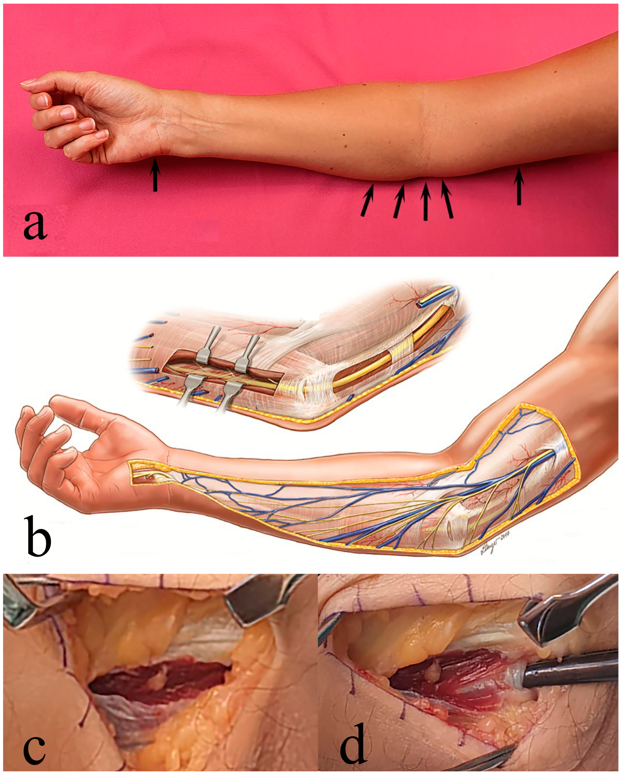 1. Potential sites of ulnar nerve compression: (1) intermuscular