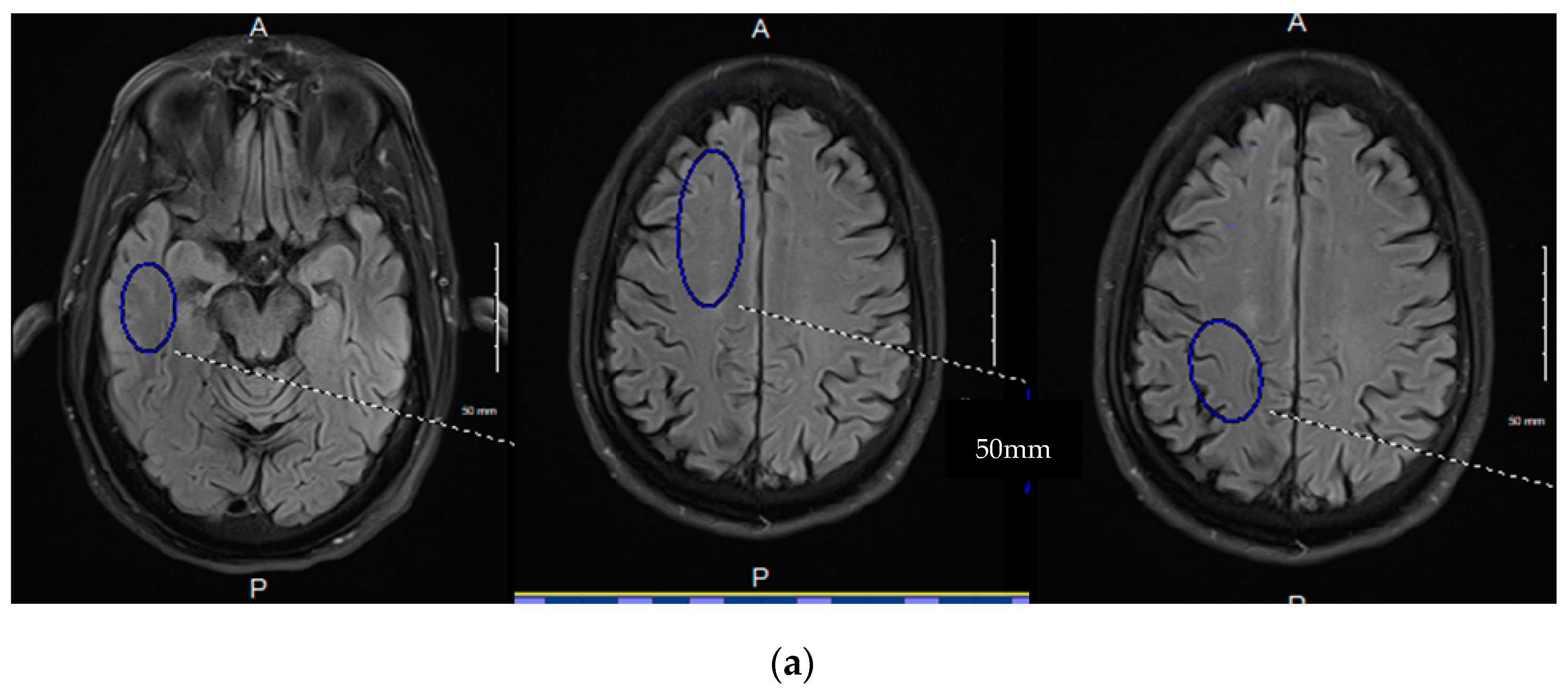 Progressive Age-Associated Blood–Brain Barrier Leak 