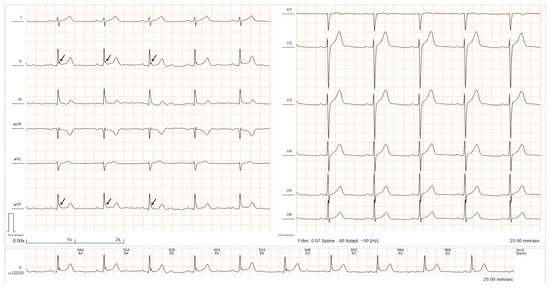 Exercise-Induced Electrocardiographic Changes in Healthy Young Males ...