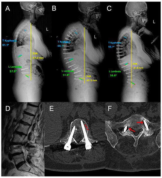 Two-Stage Lumbar Dynamic Stabilization Surgery: A Comprehensive ...
